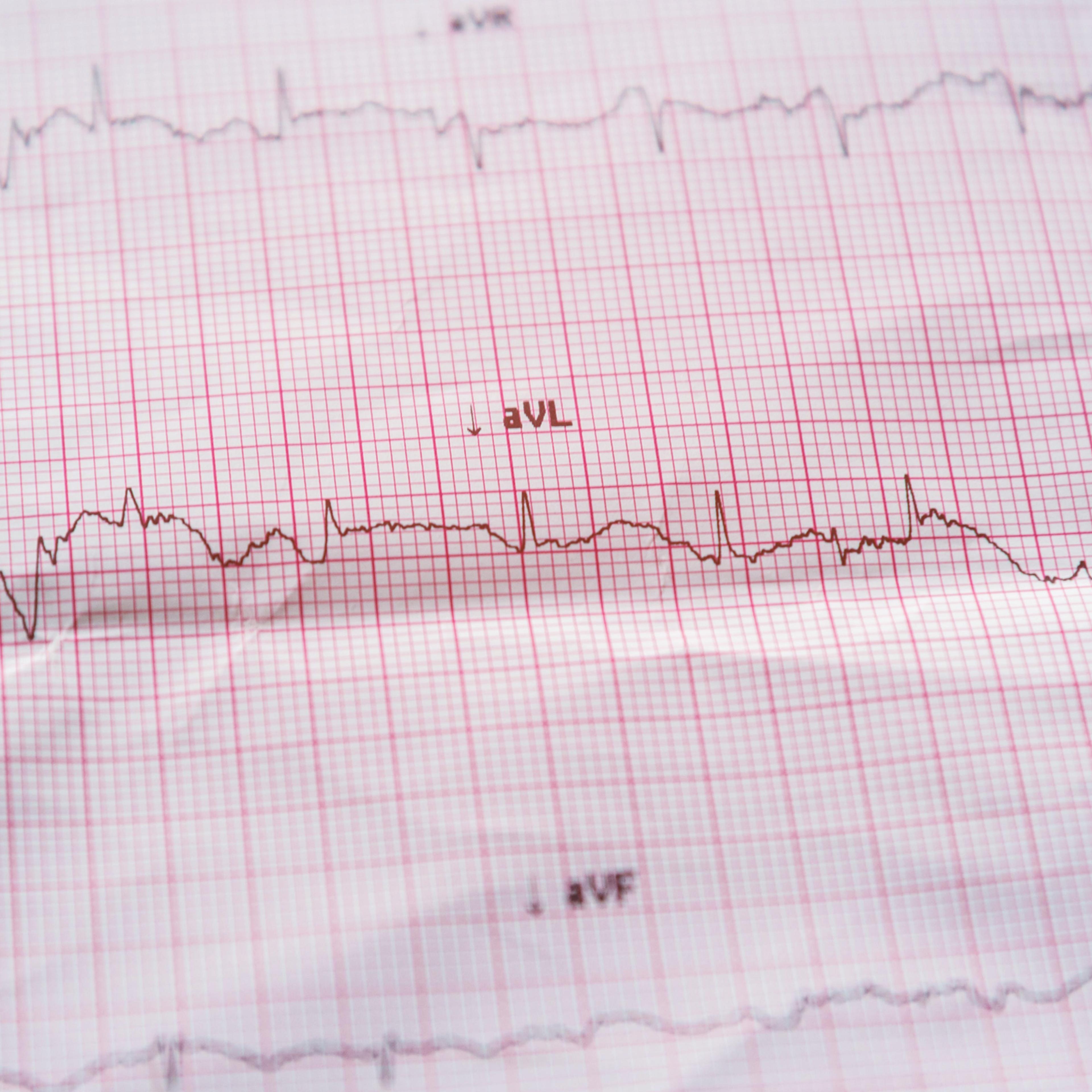 An electrocardiogram showing heart disease