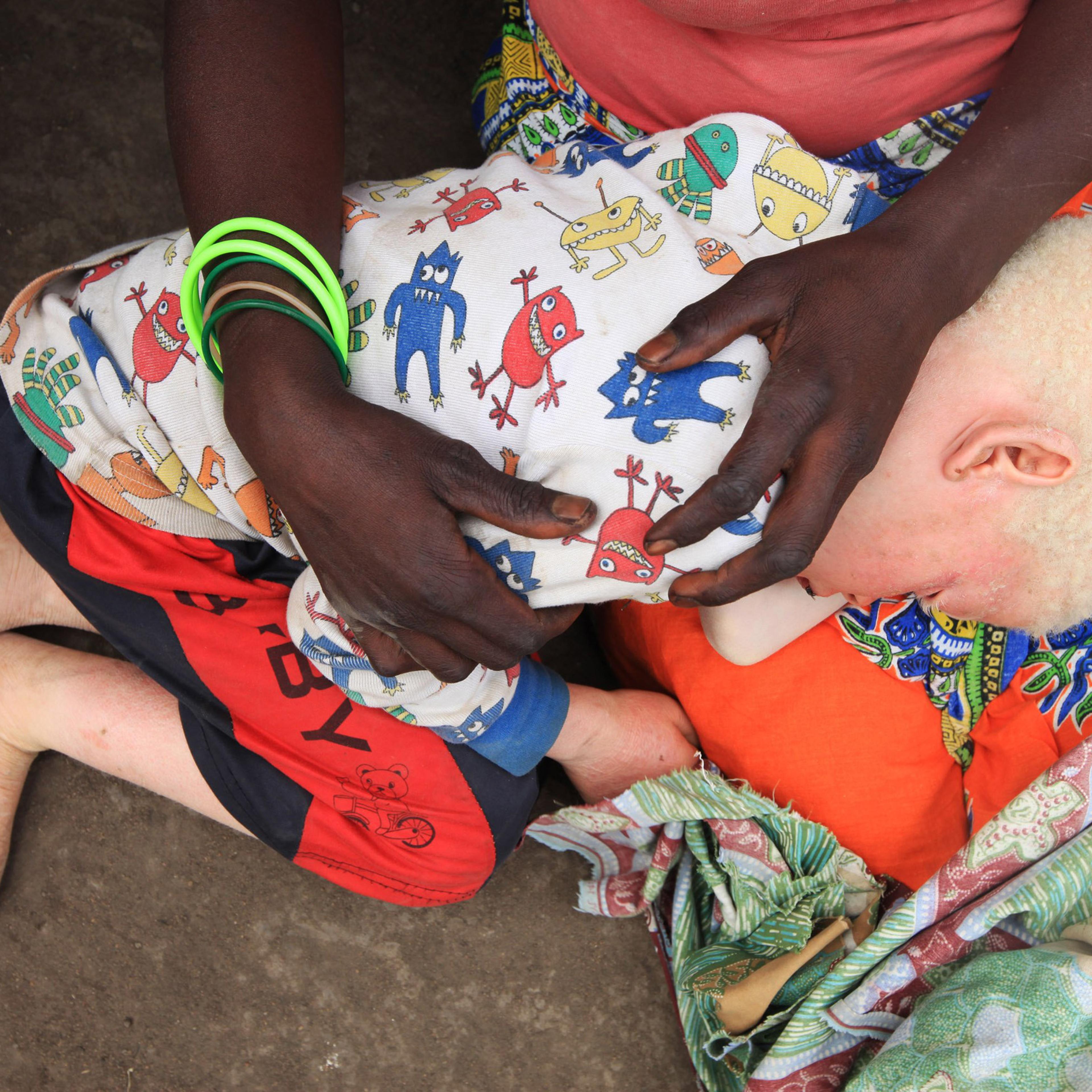 Edna Cedrick, 26, holds her surviving albino son after his twin brother who had albinism was snatched from her arms, in Machinga north east of Blantyre, Malawi, May, 24, 2016.