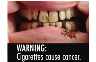 does cigarettes increase metabolism Effects of Cigarette Smoking on Metabolism and Effectiveness of Systemic  Therapy for Lung Cancer
