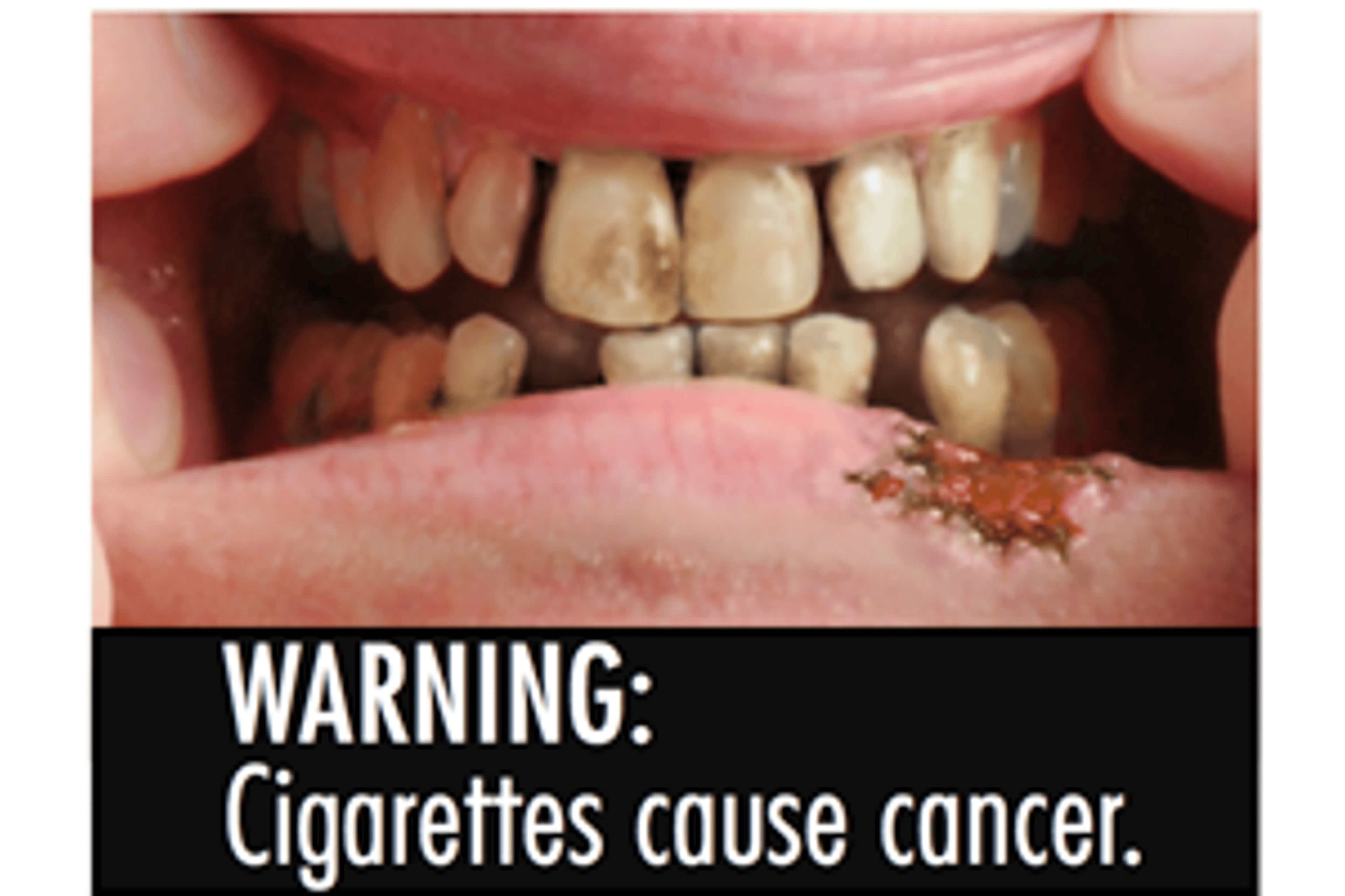la cigarette cause le cancer Pictures Better Than Words For Scaring Smokers off Cigarettes How does smoking cause cancer?