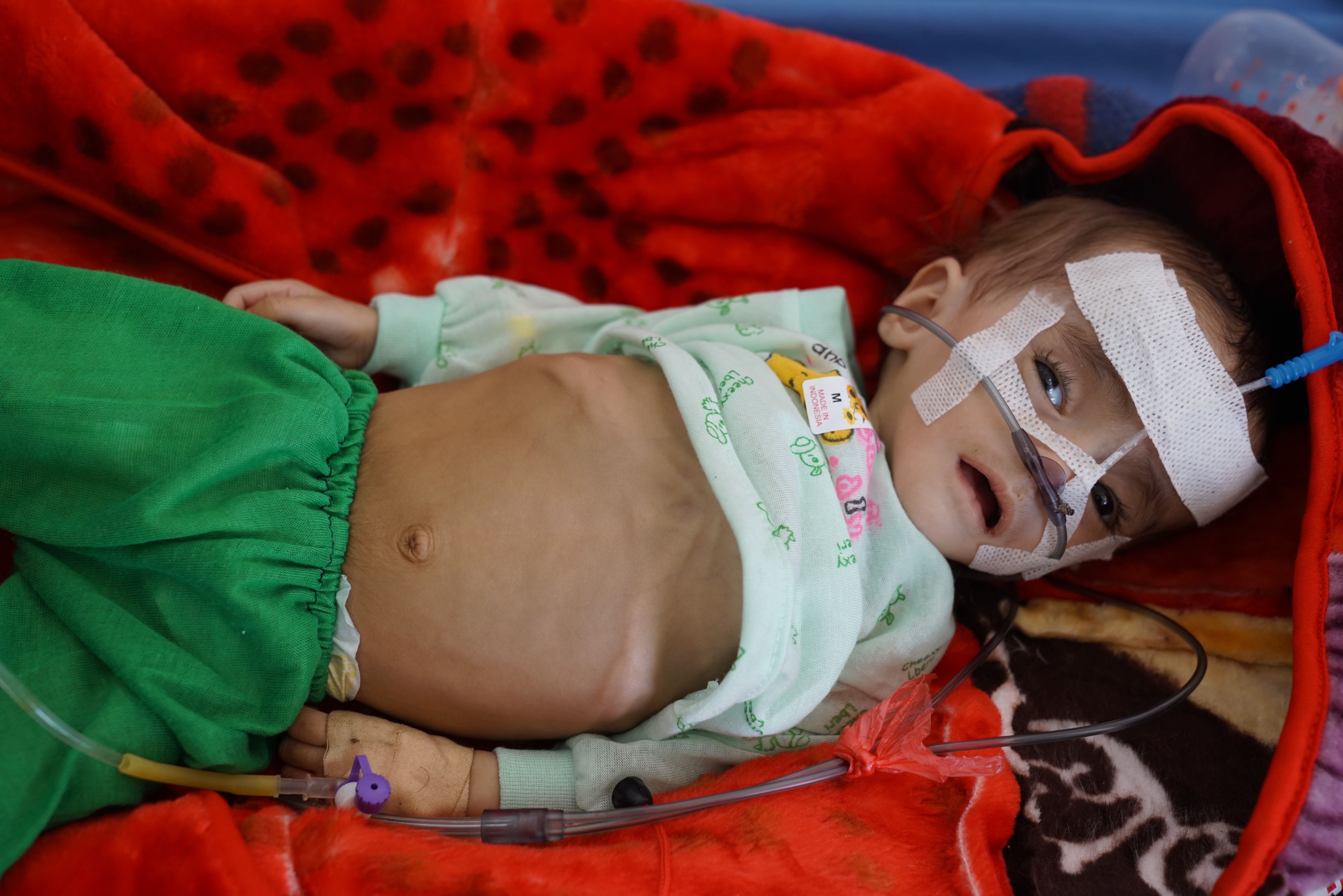 MALNOURISHED BABY IN YEMEN