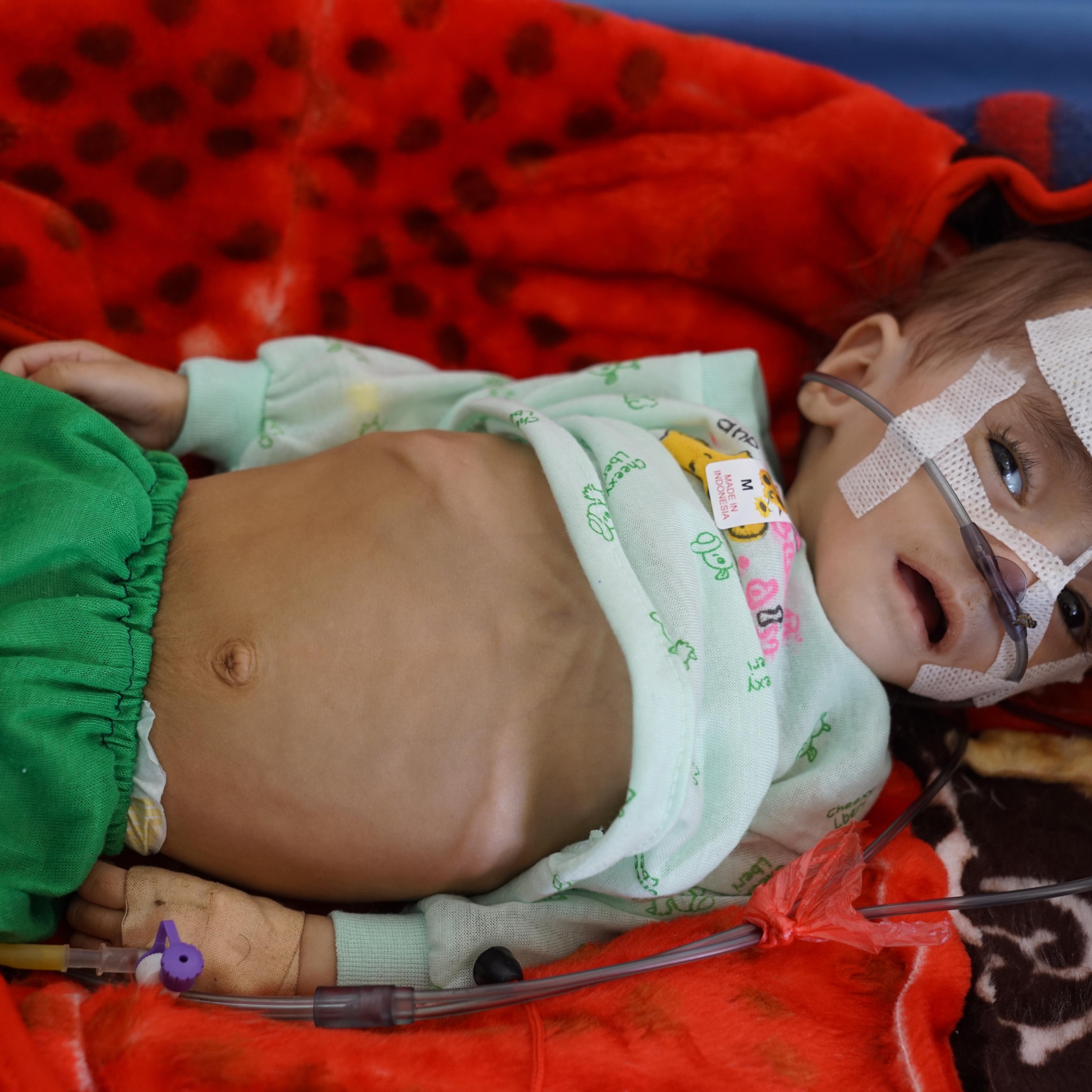 MALNOURISHED BABY IN YEMEN