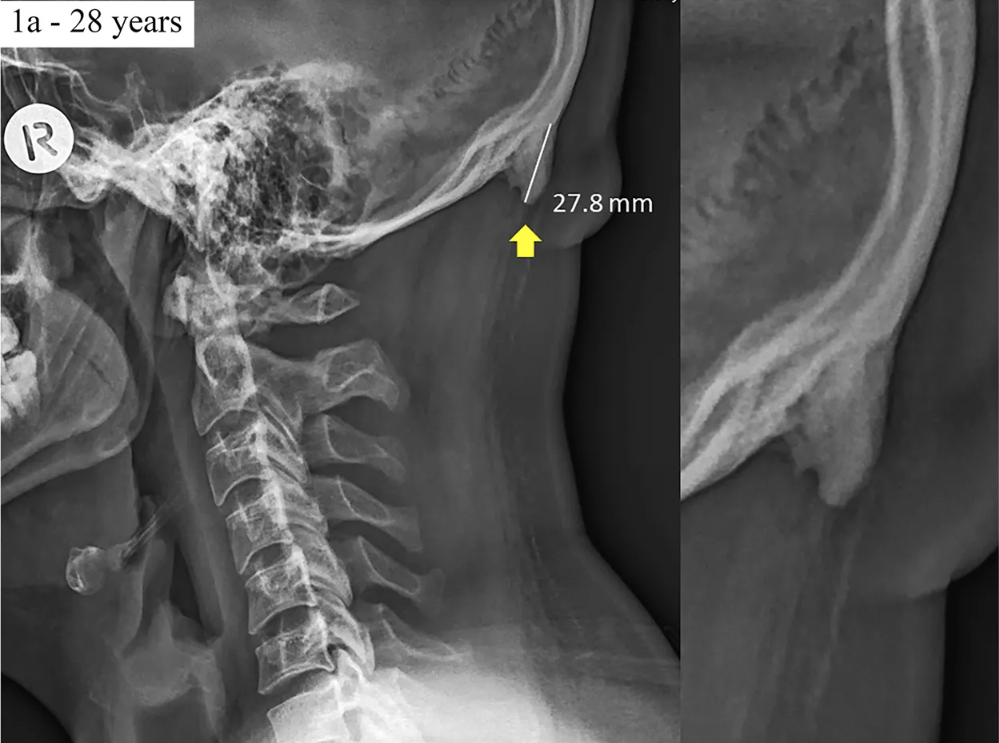 Skull horns X-ray