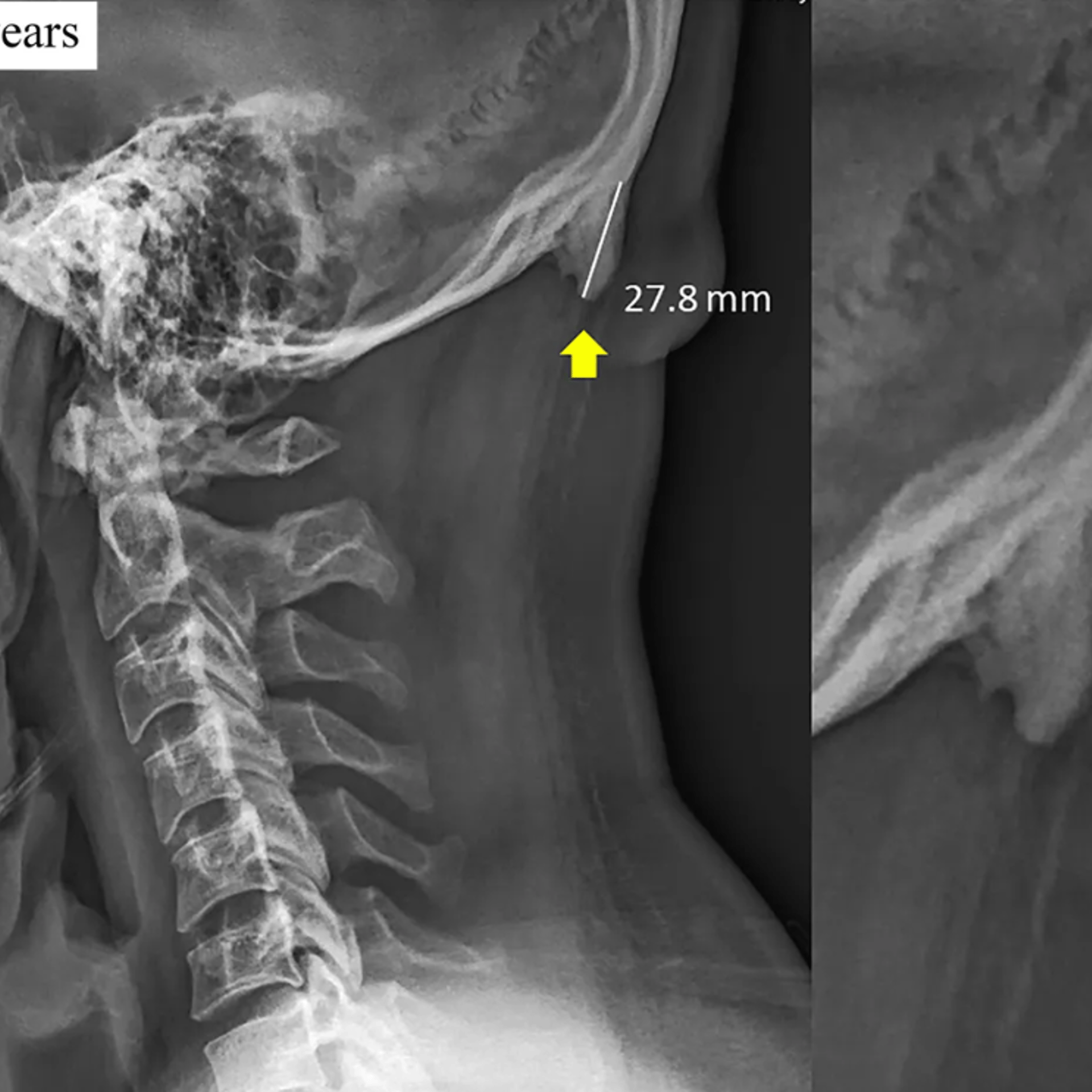Skull horns X-ray