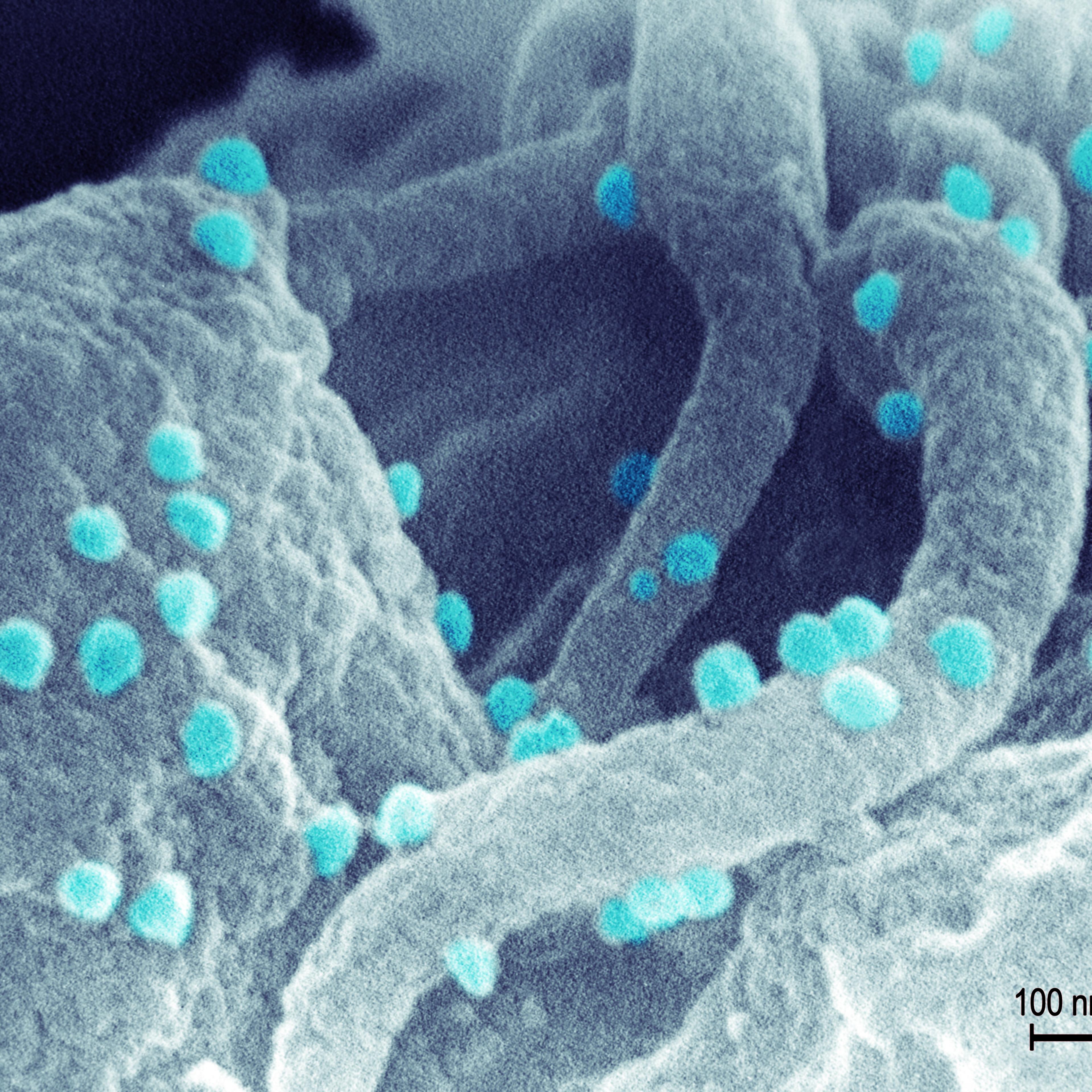 Scanning electron micrograph of HIV-1