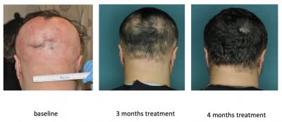 This image shows the effect of an FDA-approved drug that restored hair growth in a research subject with alopecia areata. Left to right: at baseline, at 3 months, and at 4 months of treatment.
