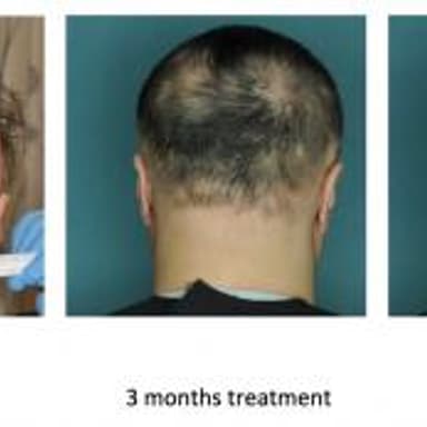 This image shows the effect of an FDA-approved drug that restored hair growth in a research subject with alopecia areata. Left to right: at baseline, at 3 months, and at 4 months of treatment.