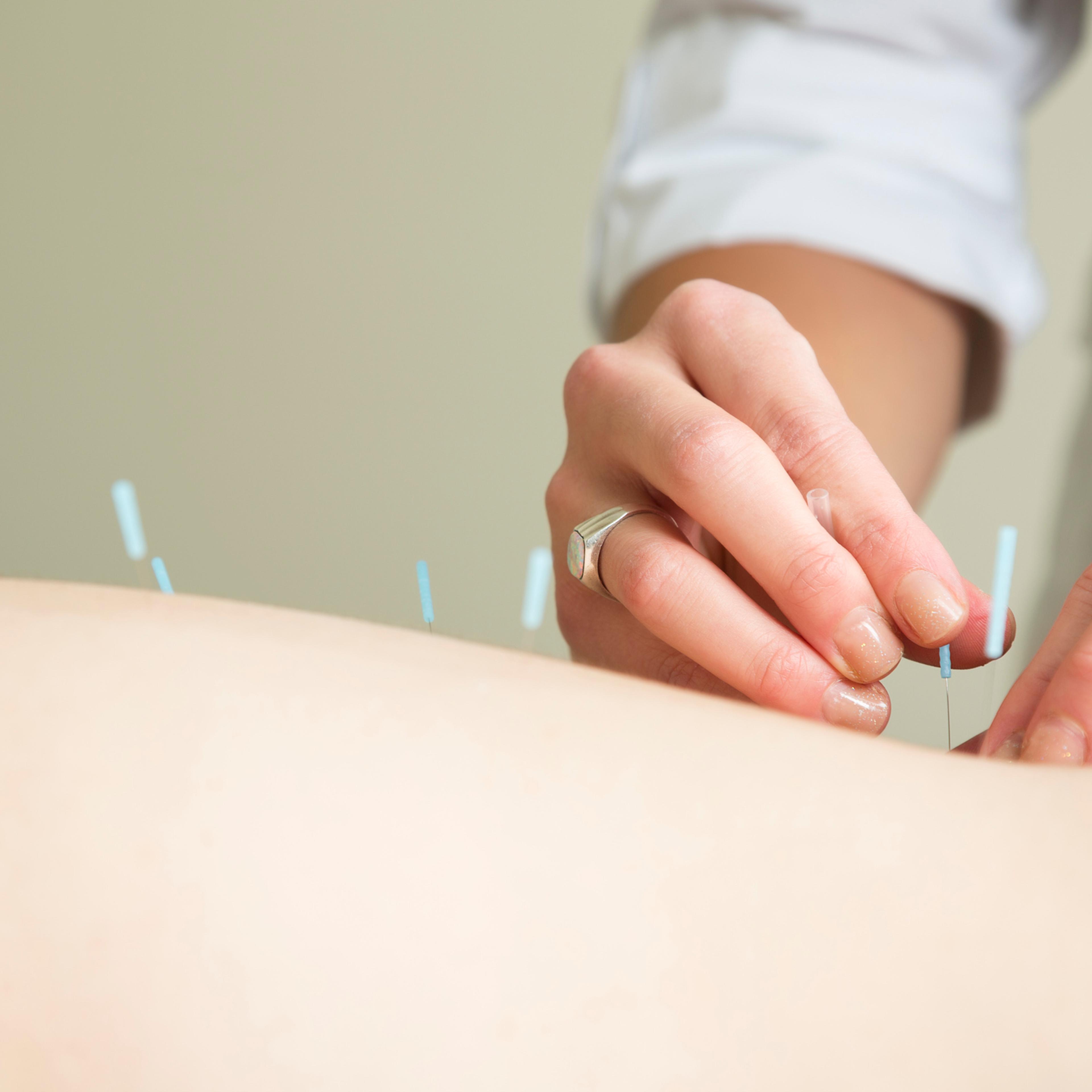 acupuncture-health-benefits