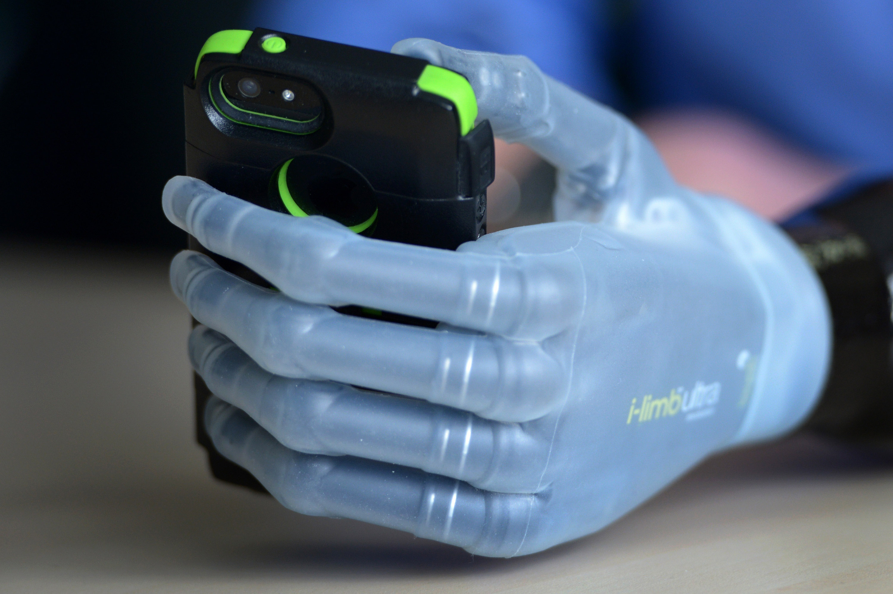 First Person In The UK To Be Fitted With The I-limb Ultra Revolution Bionic Hand.