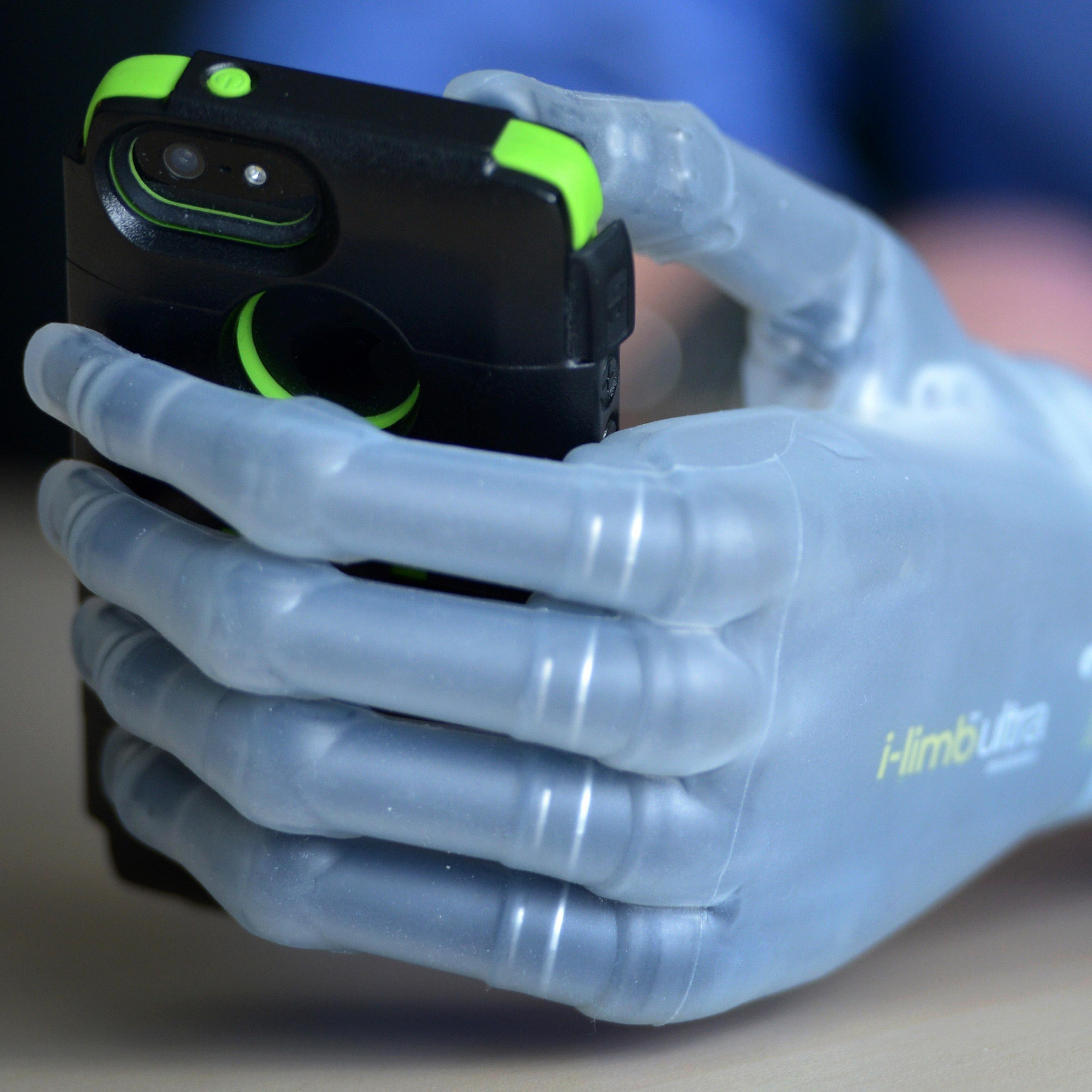 First Person In The UK To Be Fitted With The I-limb Ultra Revolution Bionic Hand.