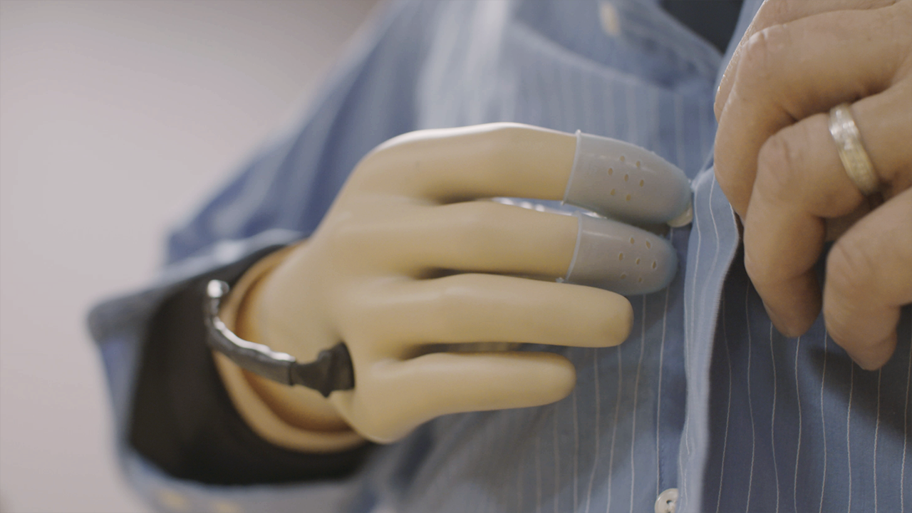An innovative prosthetic hand from researchers at Case Western Reserve University is helping people to feel again