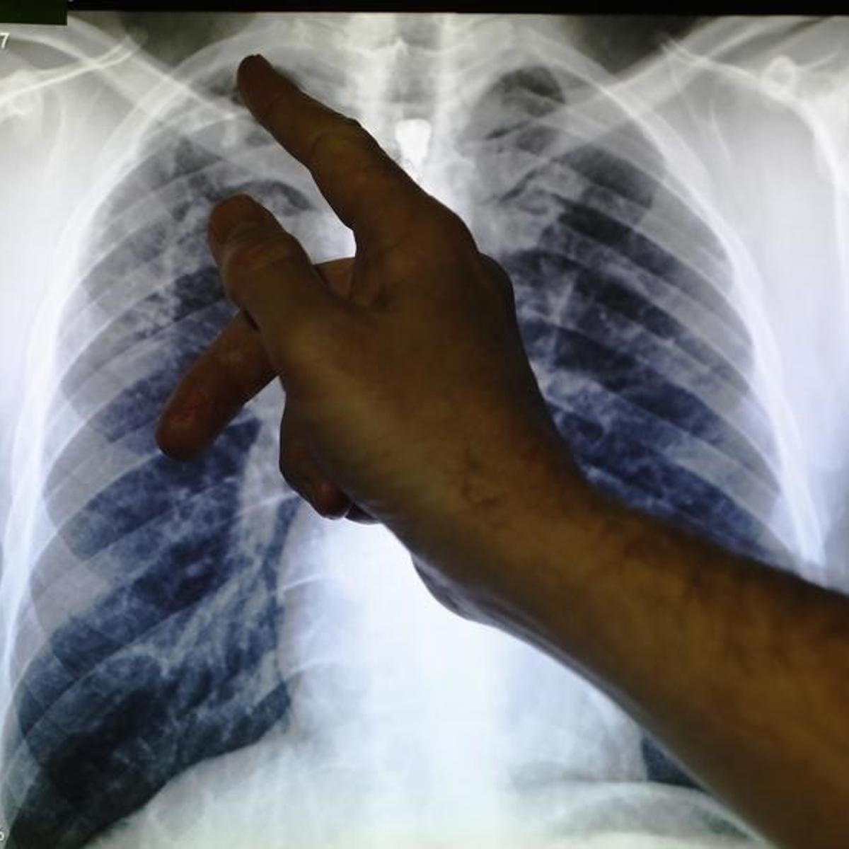 Clinical lead Doctor Al Story points to an x-ray showing a pair of lungs infected with TB (tuberculosis) during an interview with Reuters on board the mobile X-ray unit screening for TB in Ladbroke Grove in London