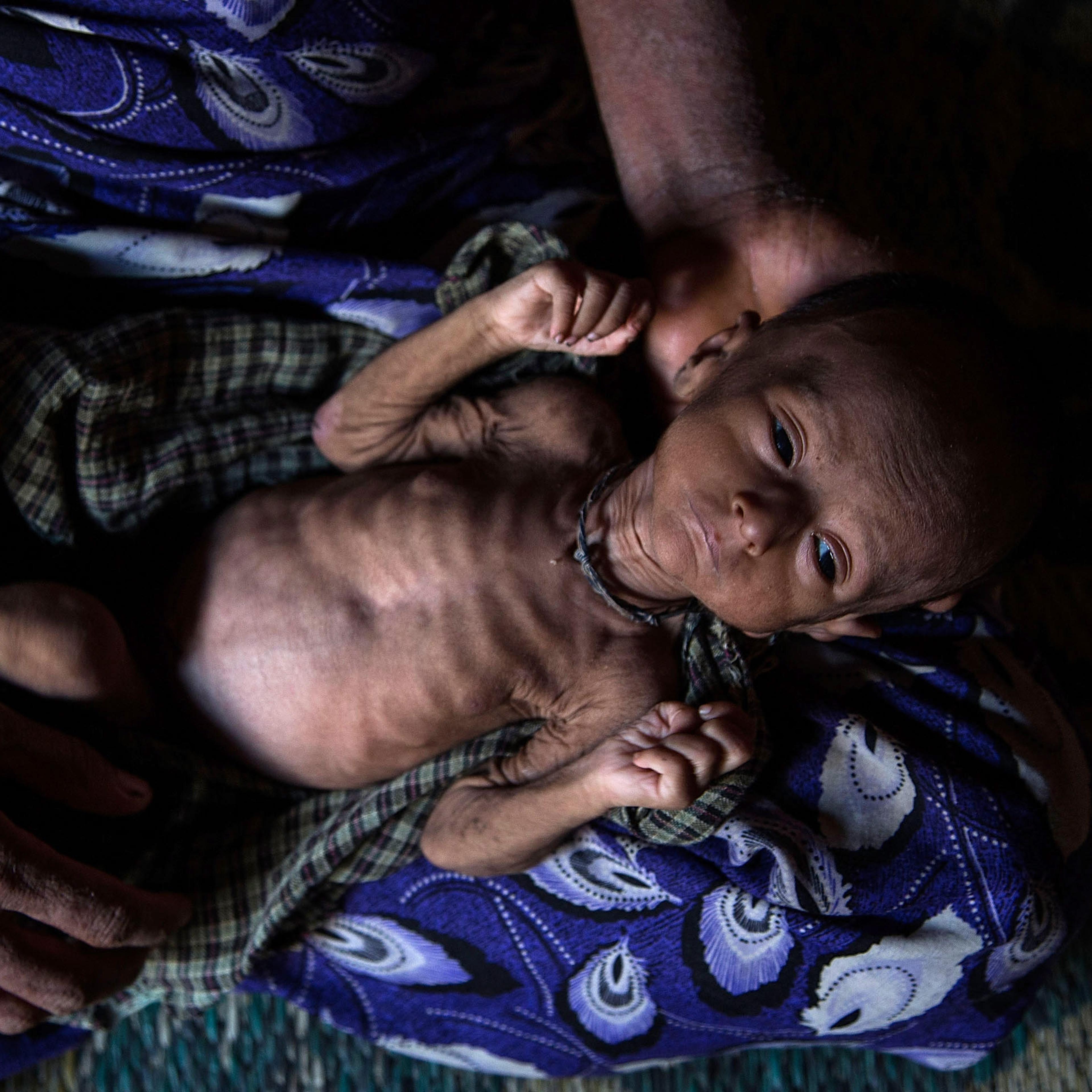 Rohingya Refugees Face Health Crisis As Myanmar
