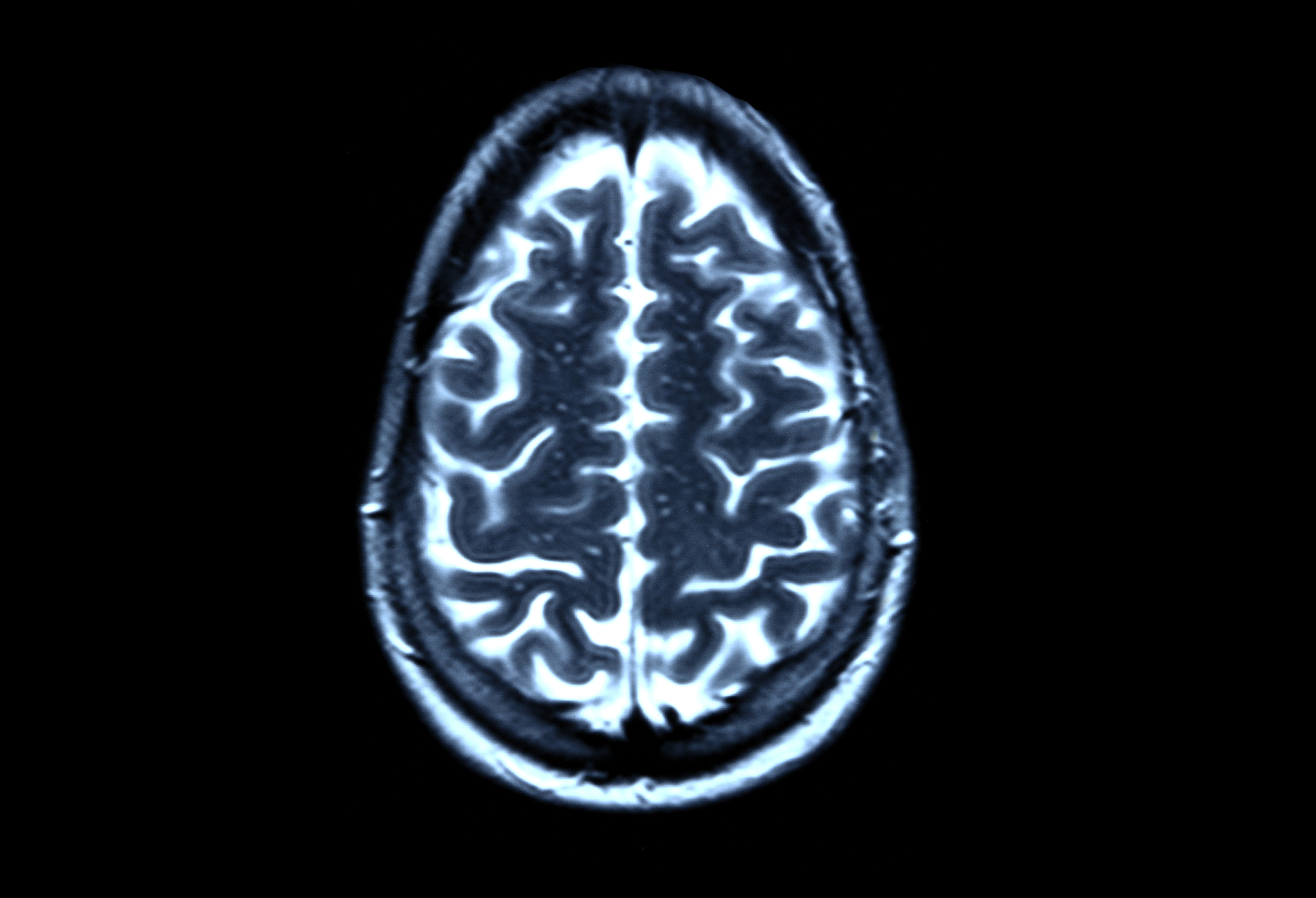 Brain scan, MRI scan