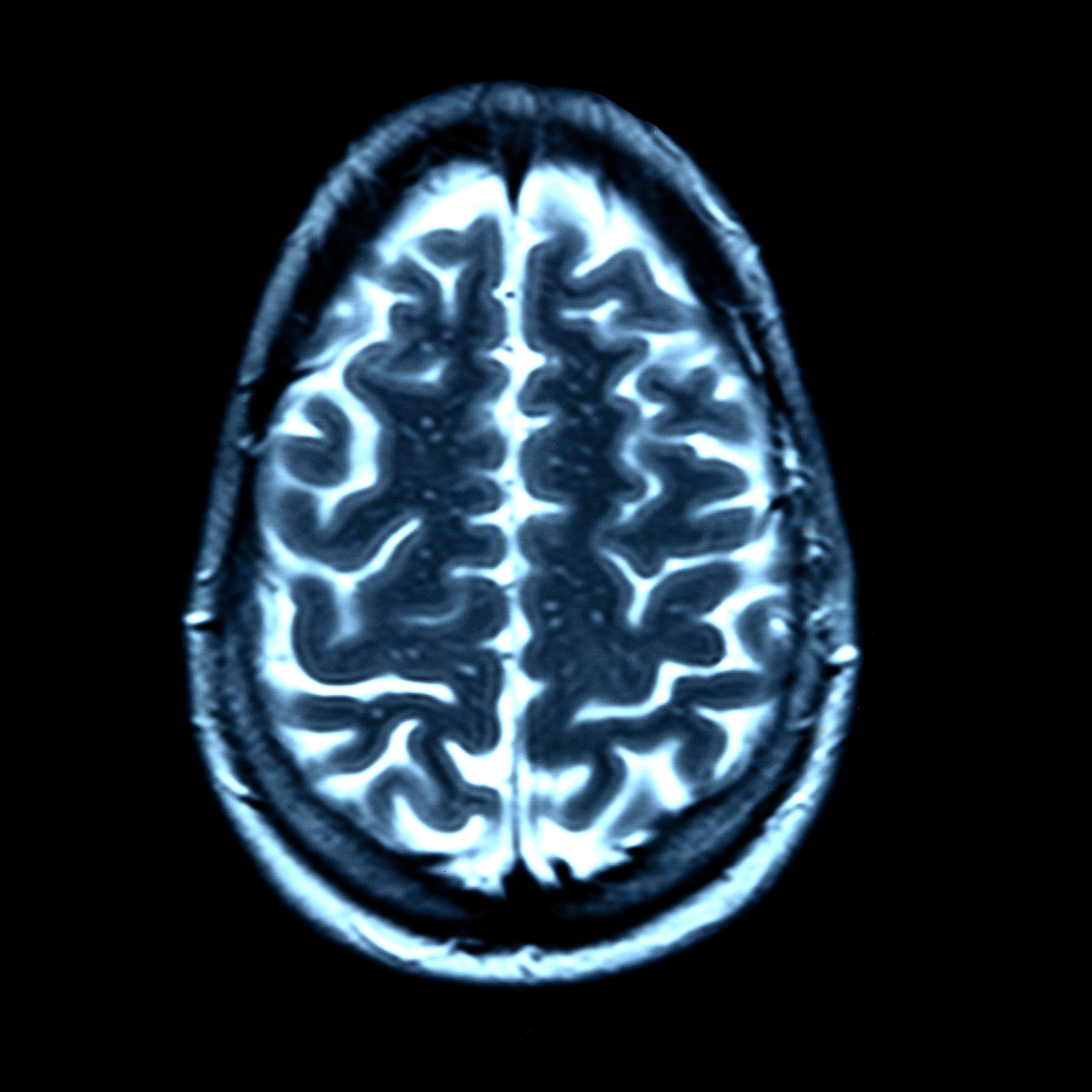 Brain scan, MRI scan
