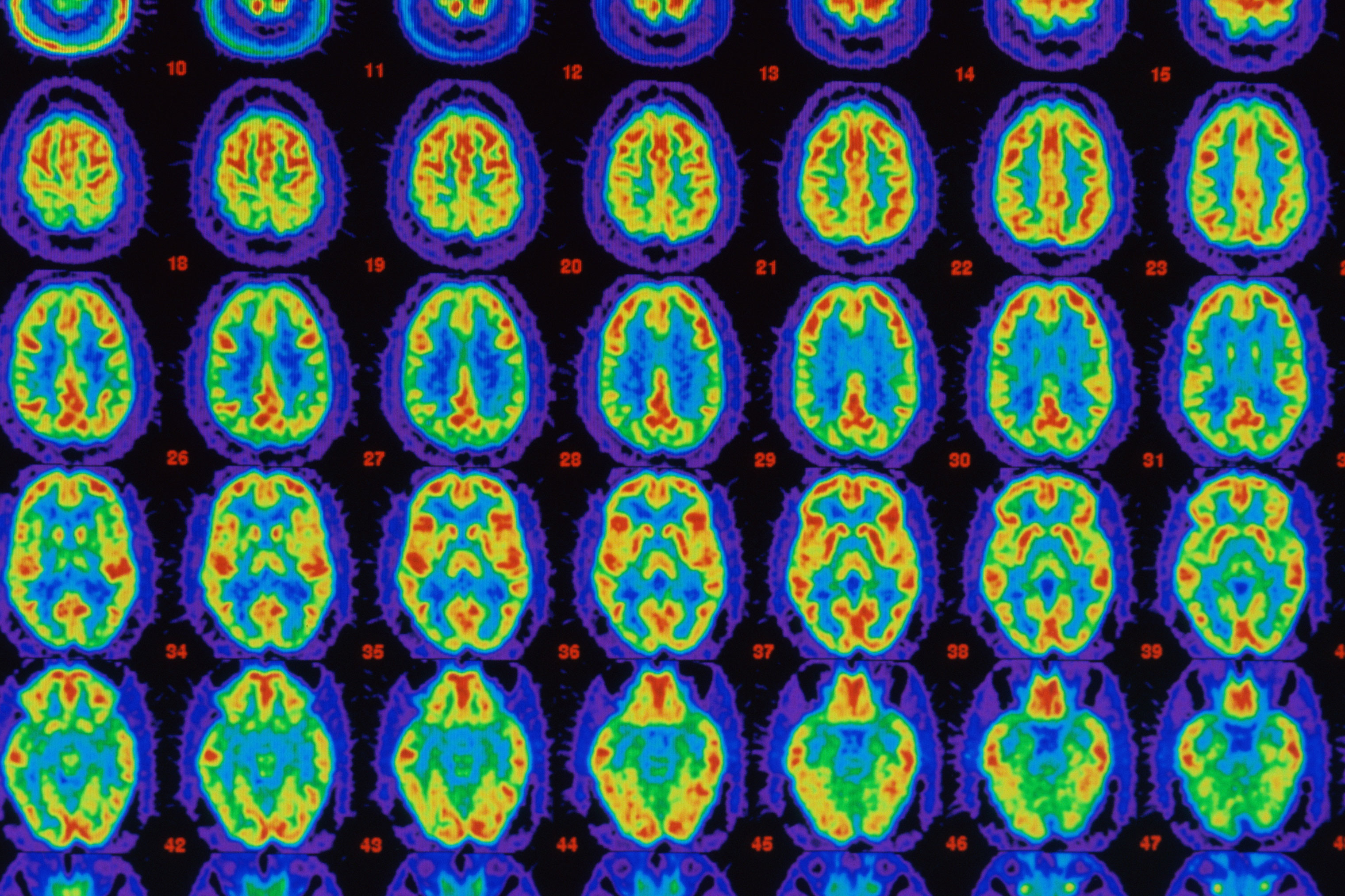 Positron Emission Tomography (PET) is used in the diagnosis and treatment of brain diseases.