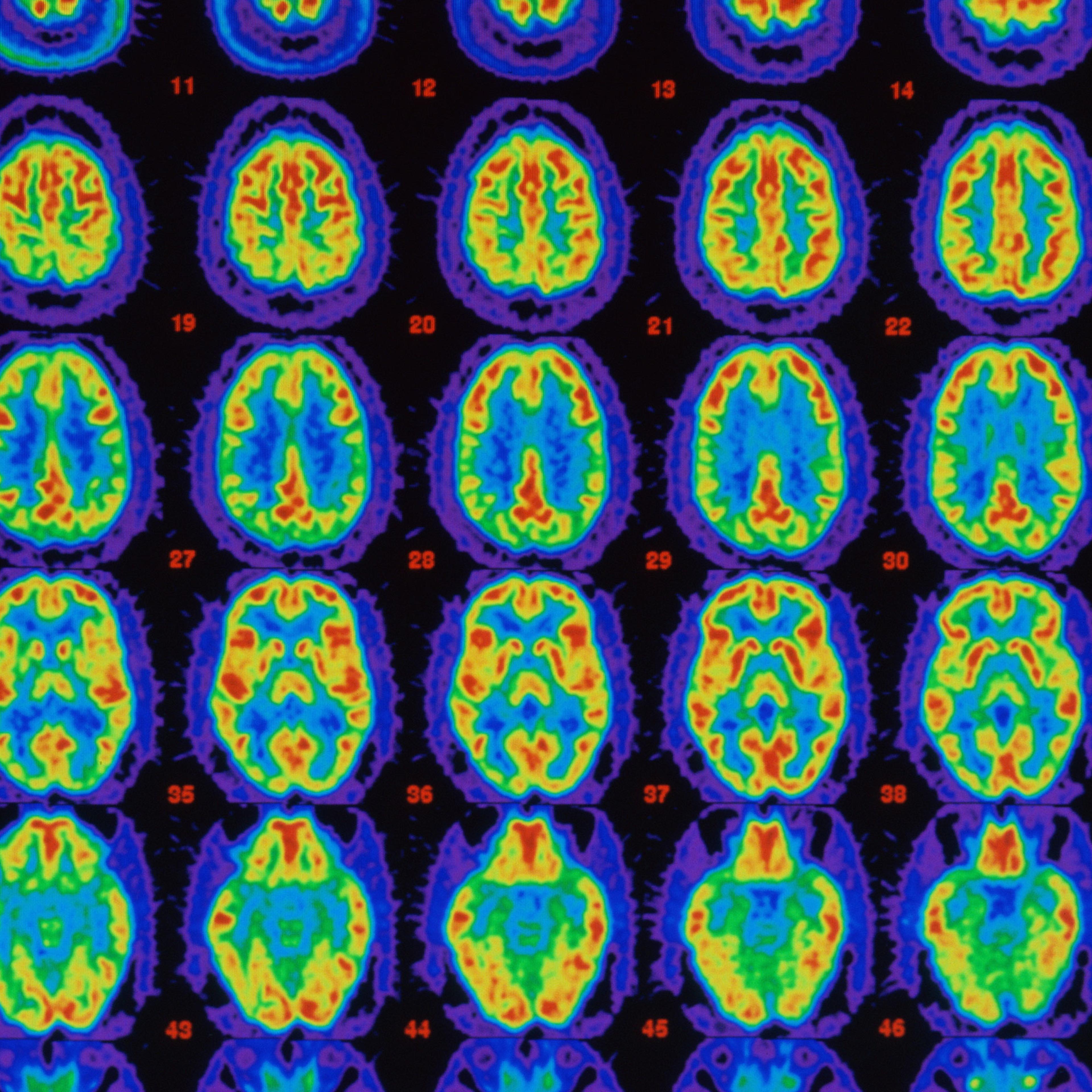Positron Emission Tomography (PET) is used in the diagnosis and treatment of brain diseases.