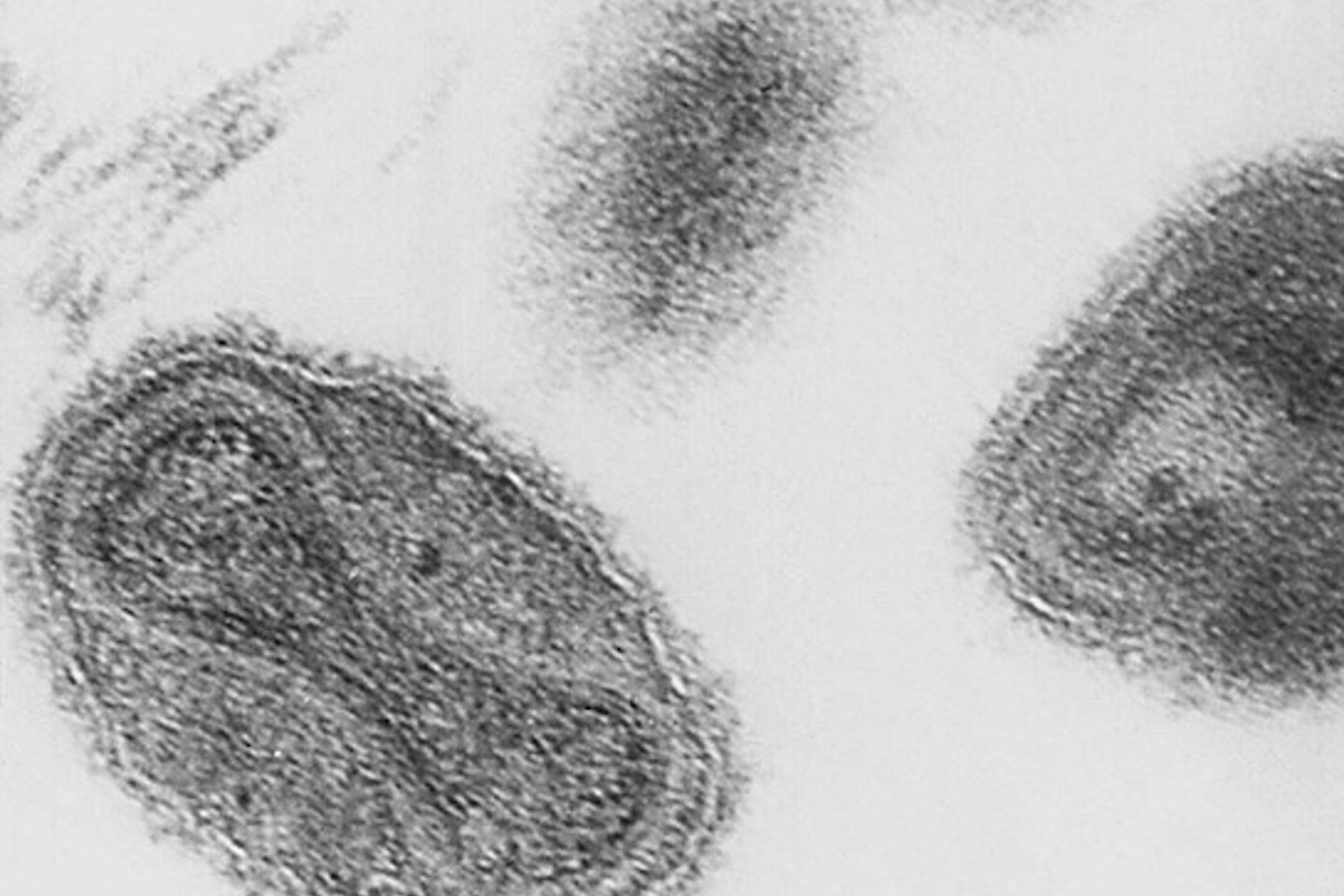 Smallpox Reference Image Vaccine History: How Smallpox, Thought Dead, Killed Again