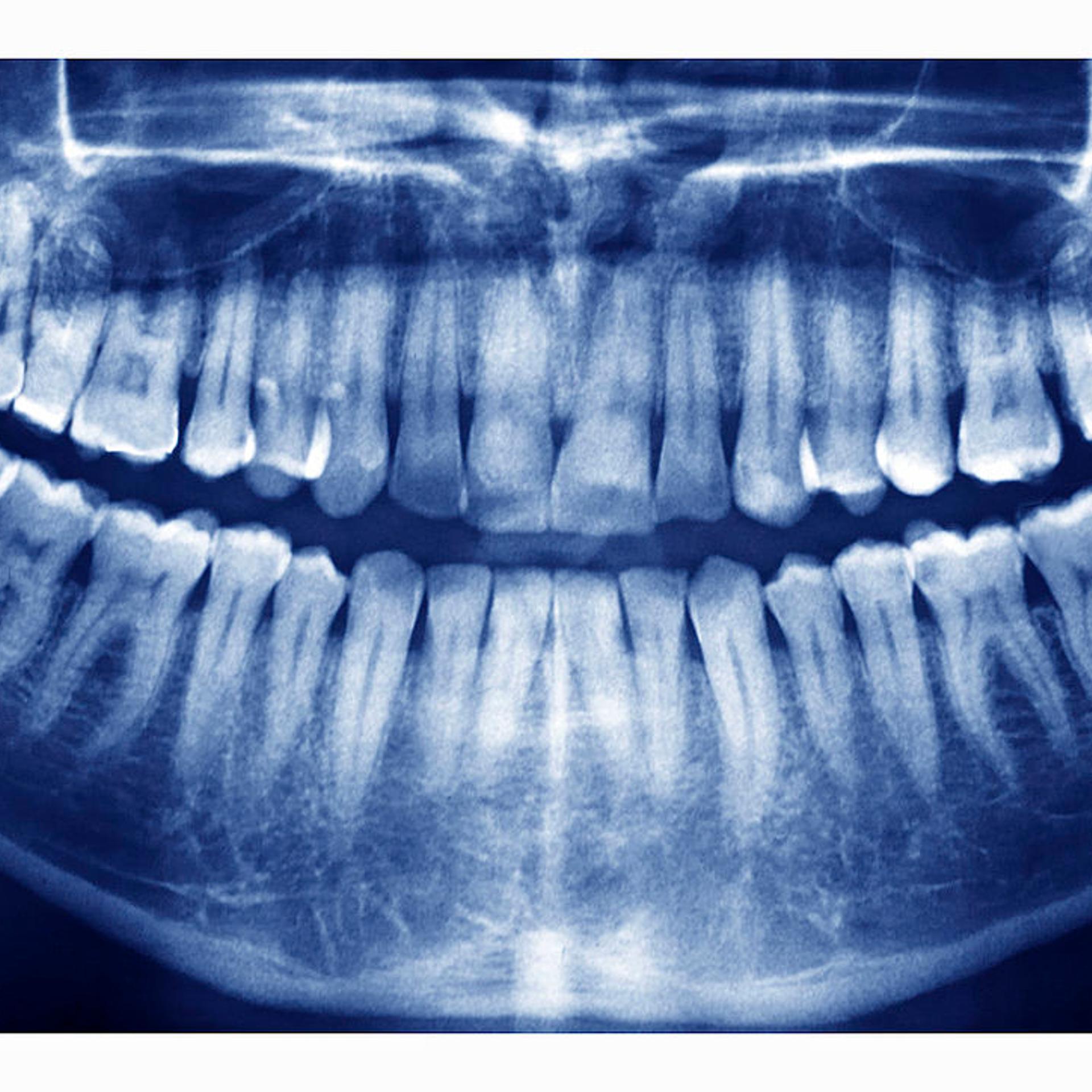 Dental X-Ray Teeth