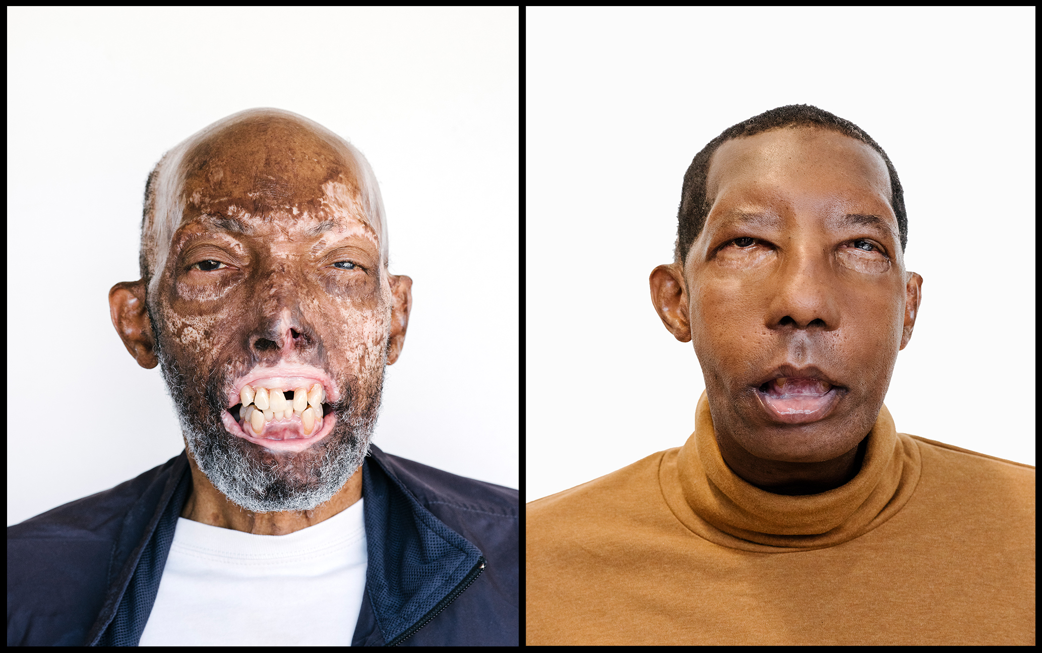 In July, Robert Chelsea became the first African-­American face-­transplant recipient