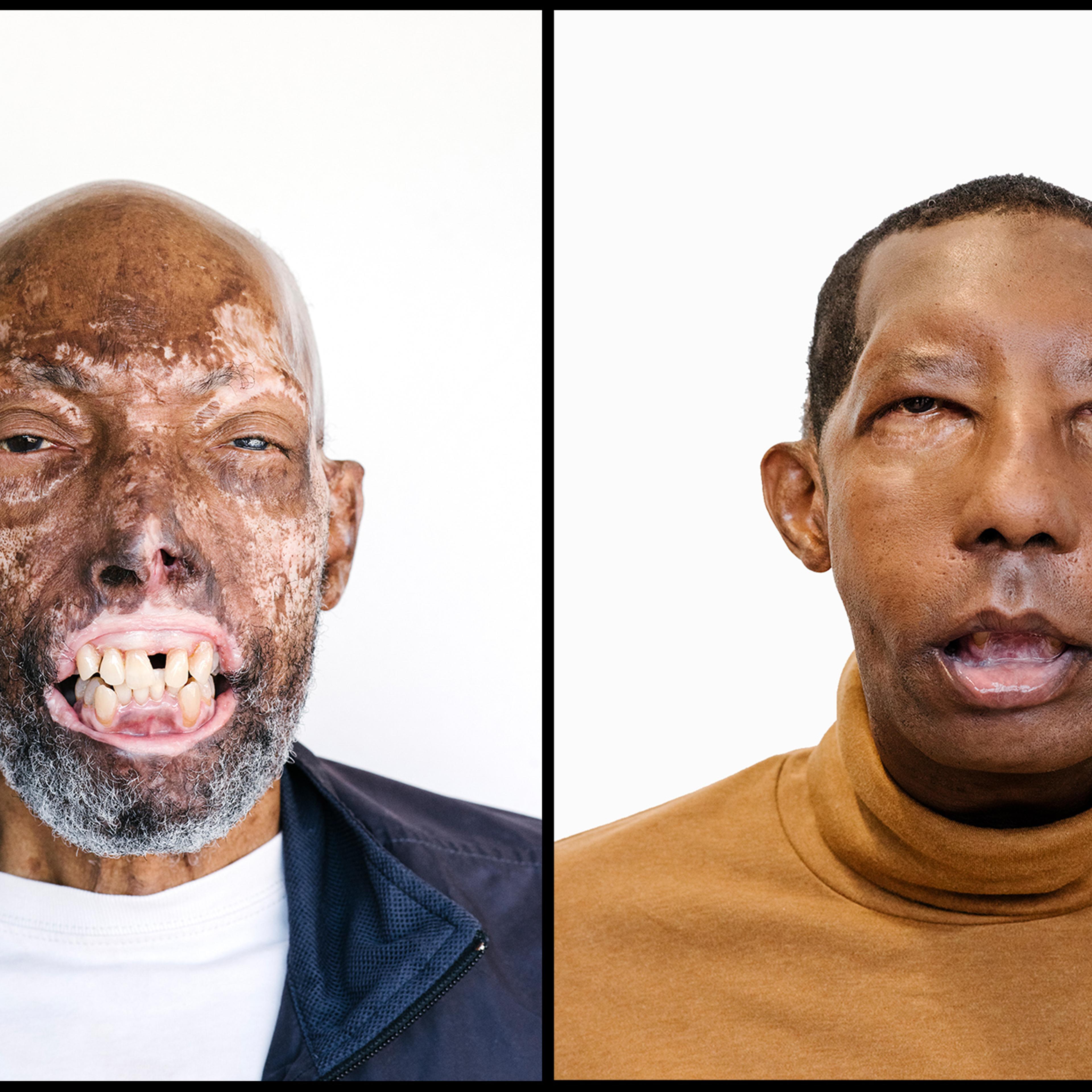 In July, Robert Chelsea became the first African-American face-transplant recipient