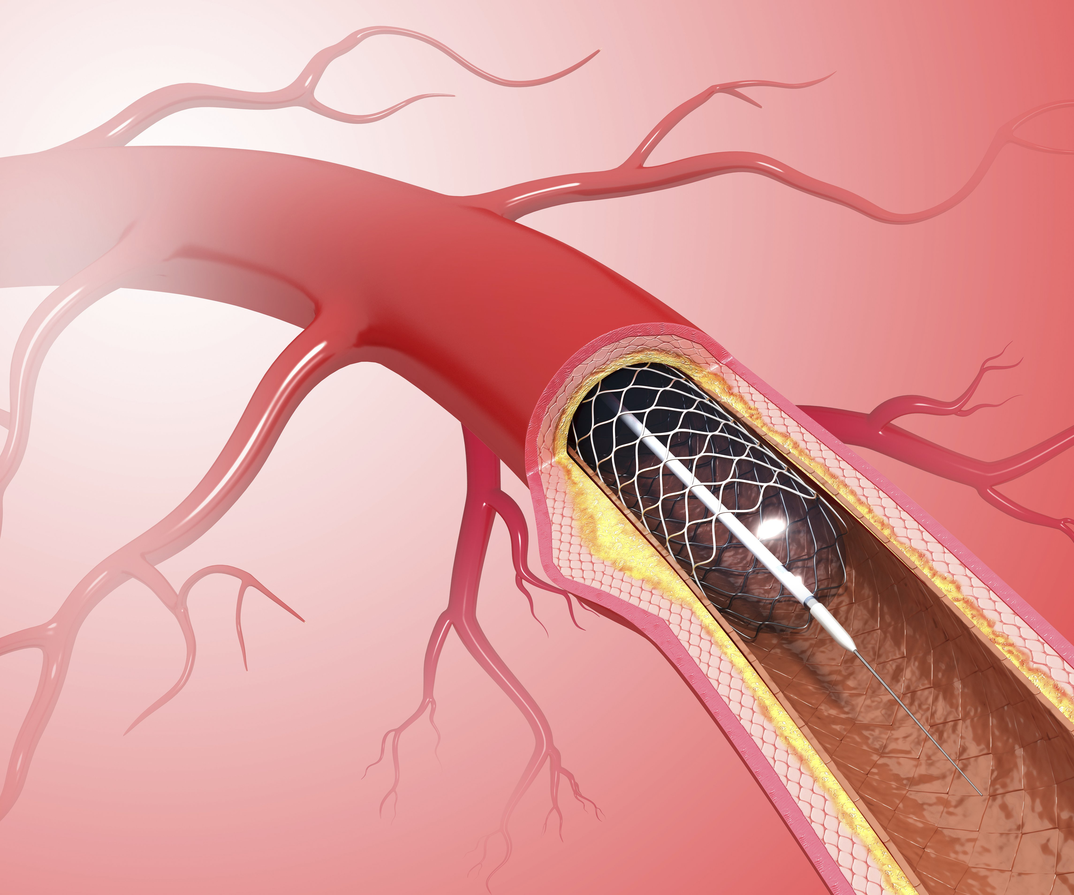 Angioplasty, artwork