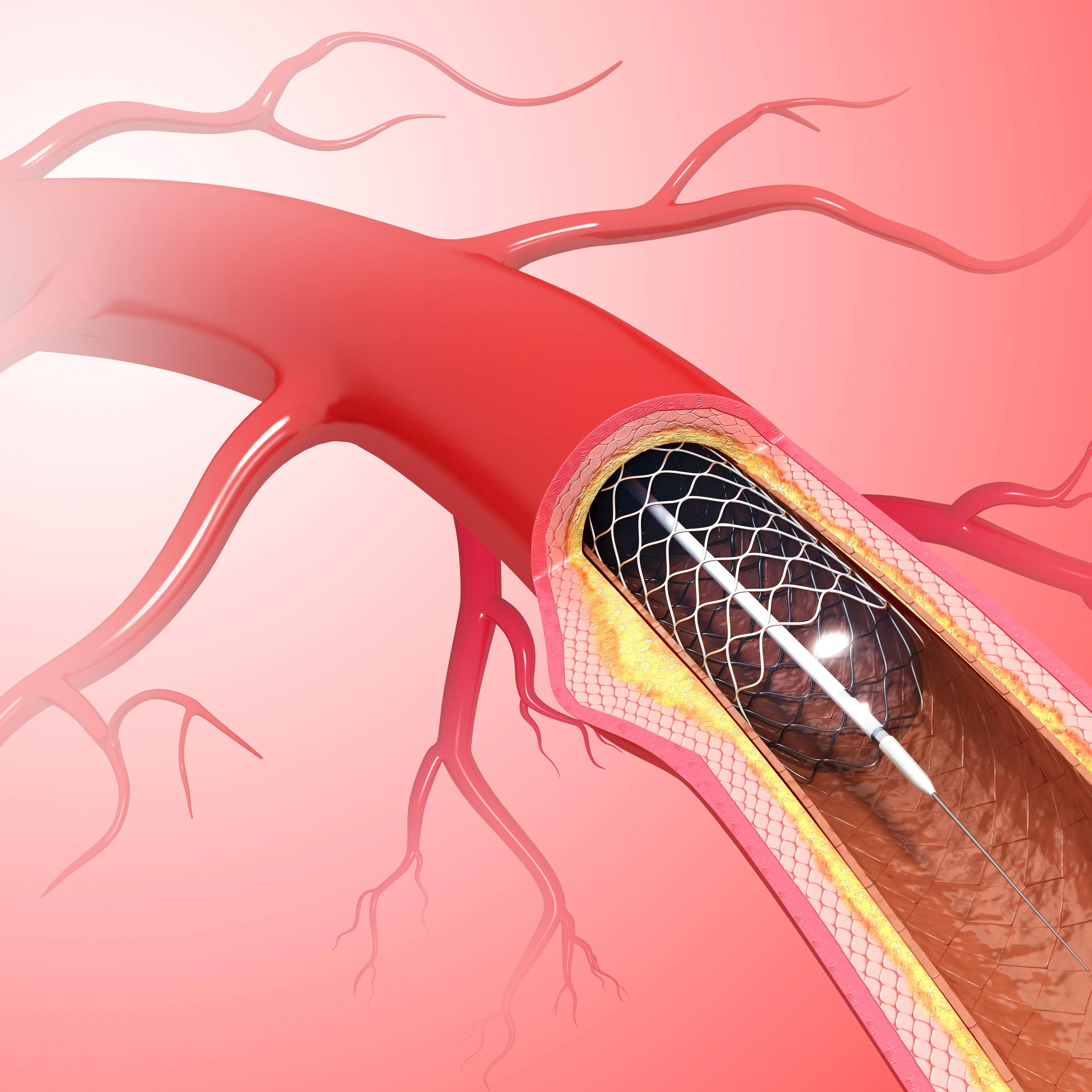 Angioplasty, artwork
