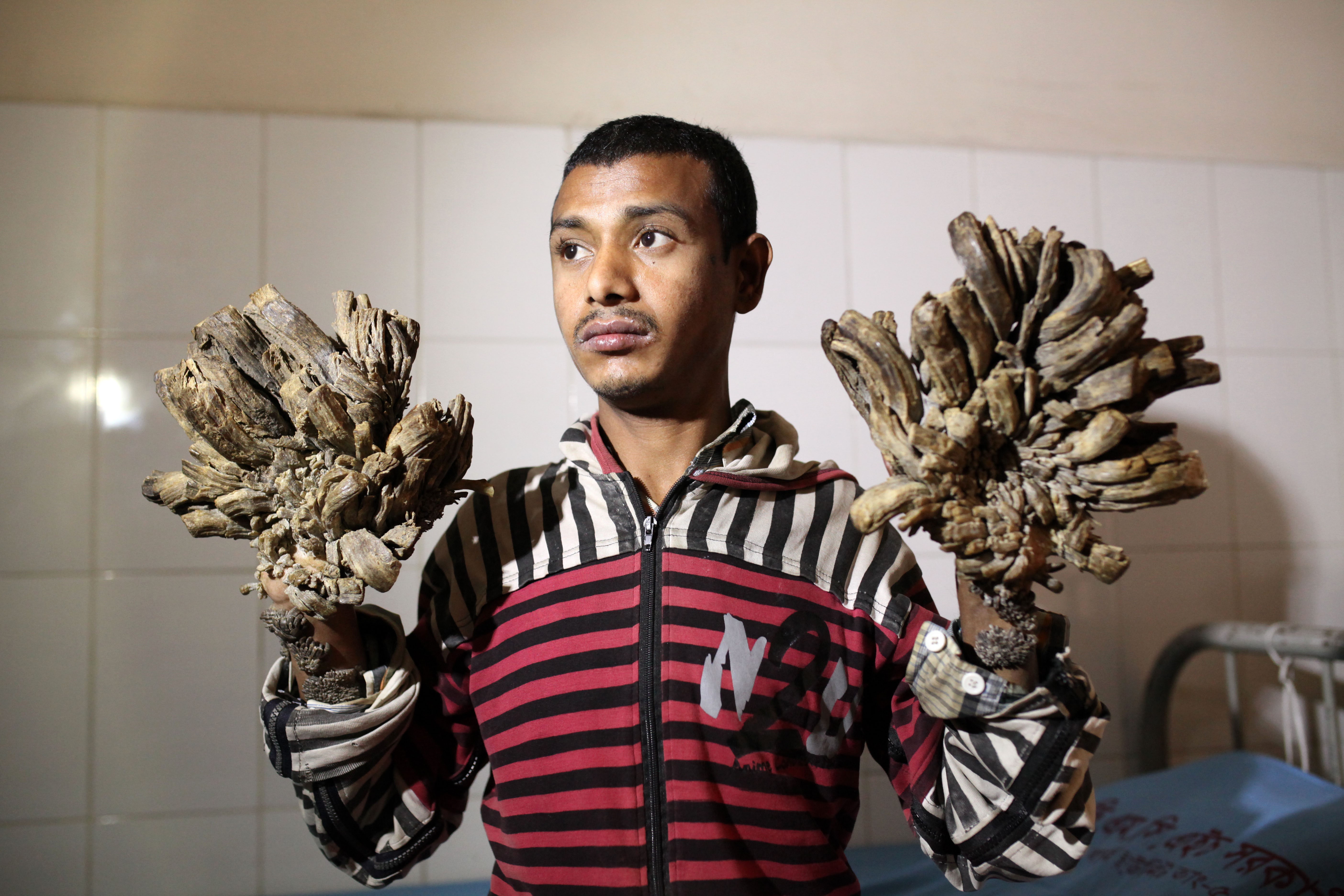 bangladesh pay tree man surgery