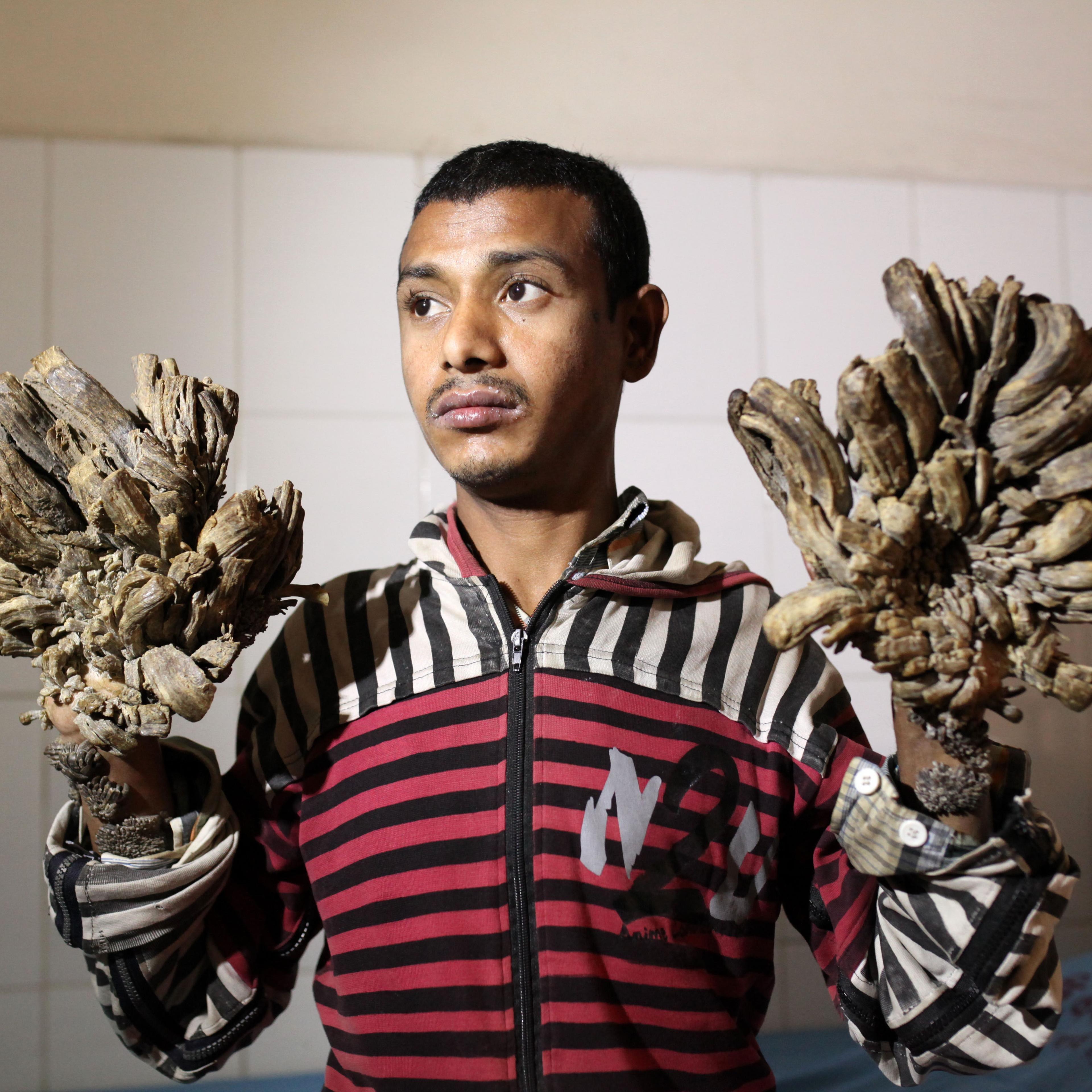 bangladesh pay tree man surgery