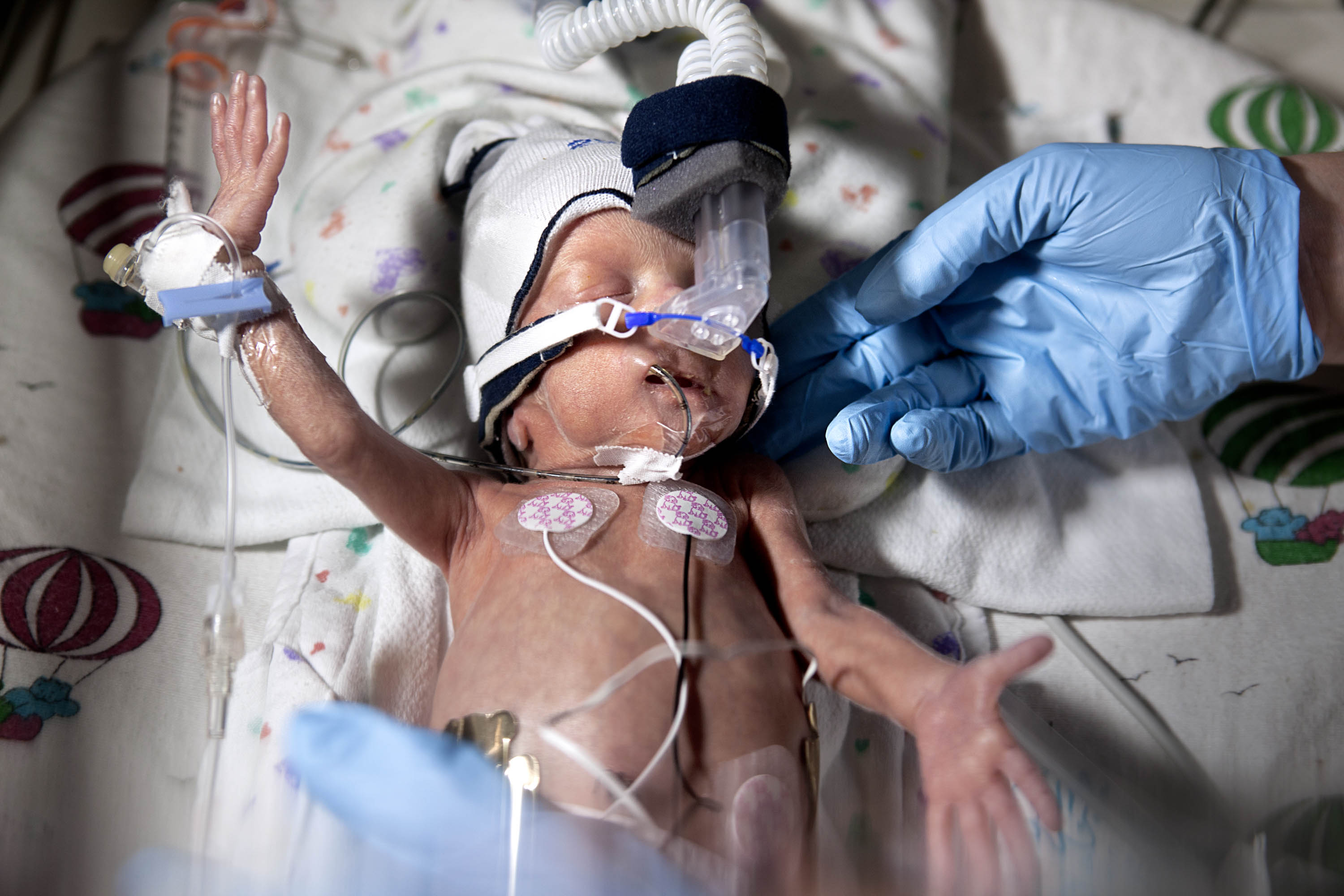 Start of the journey
David Joyce was born at 29 weeks. At 13 days old, he weighed less than 3 lb. (1.4 kg)
