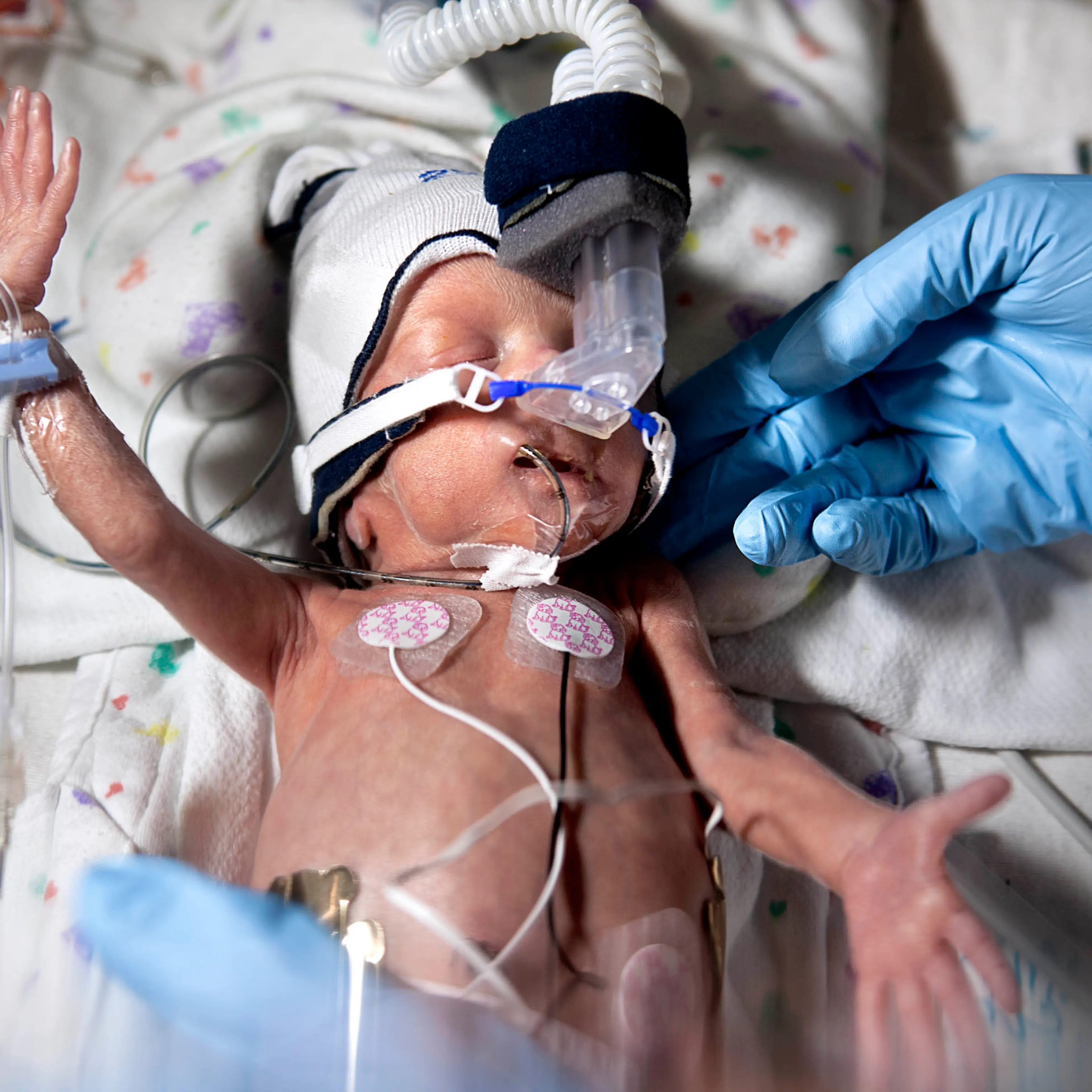 Start of the journey
David Joyce was born at 29 weeks. At 13 days old, he weighed less than 3 lb. (1.4 kg)