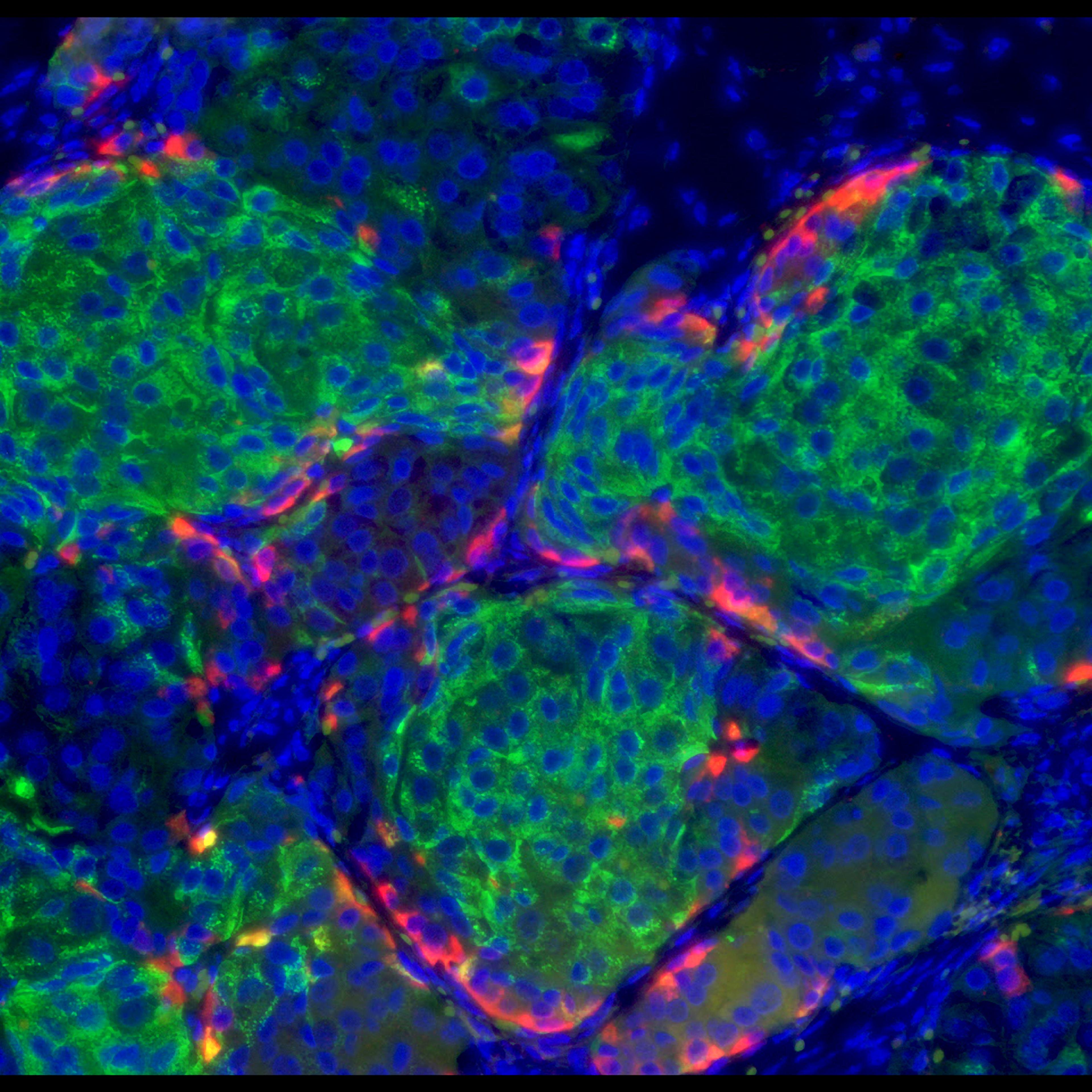 Human stem cell derived beta cells