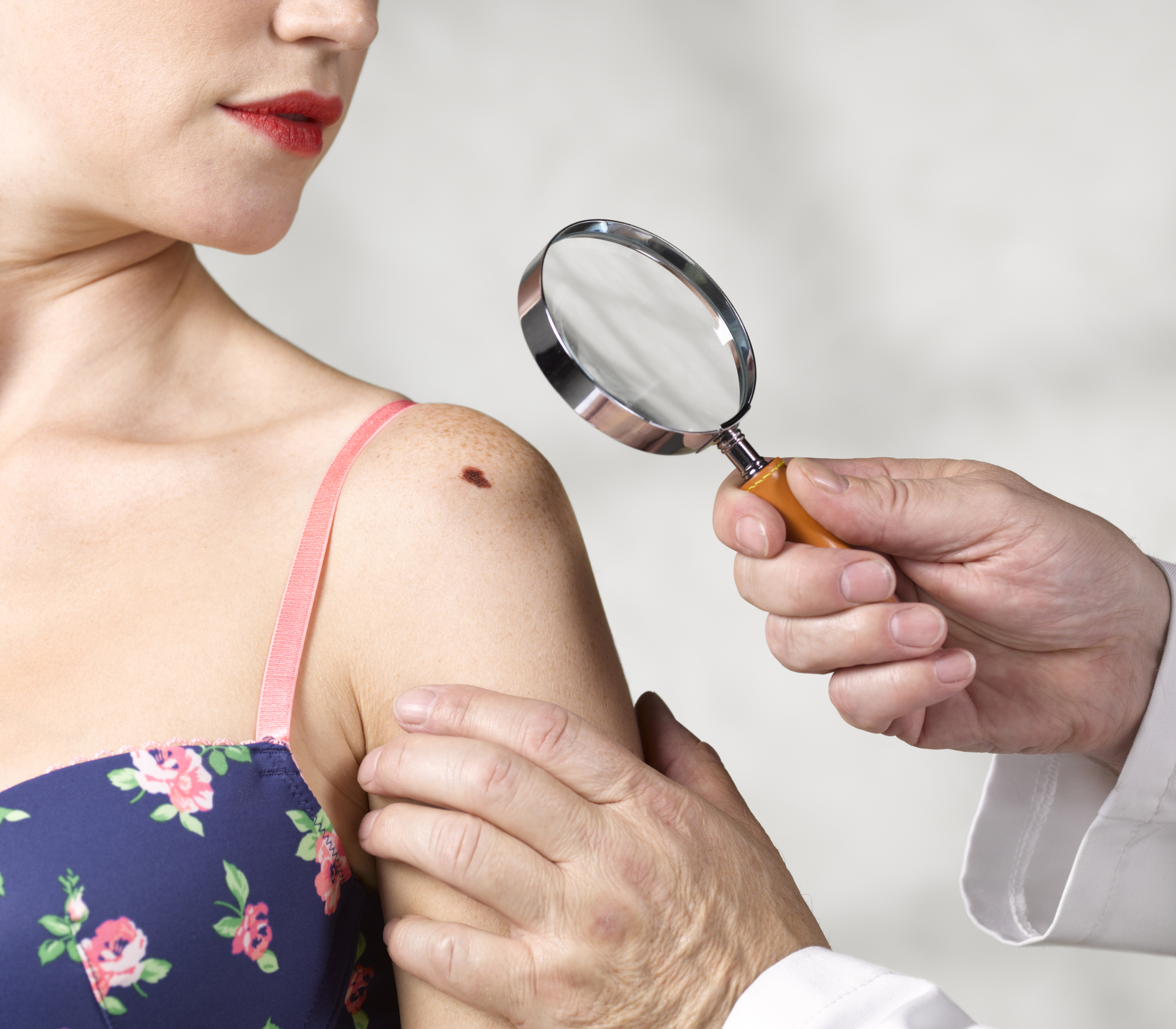 Dermatologist inspecting melanoma