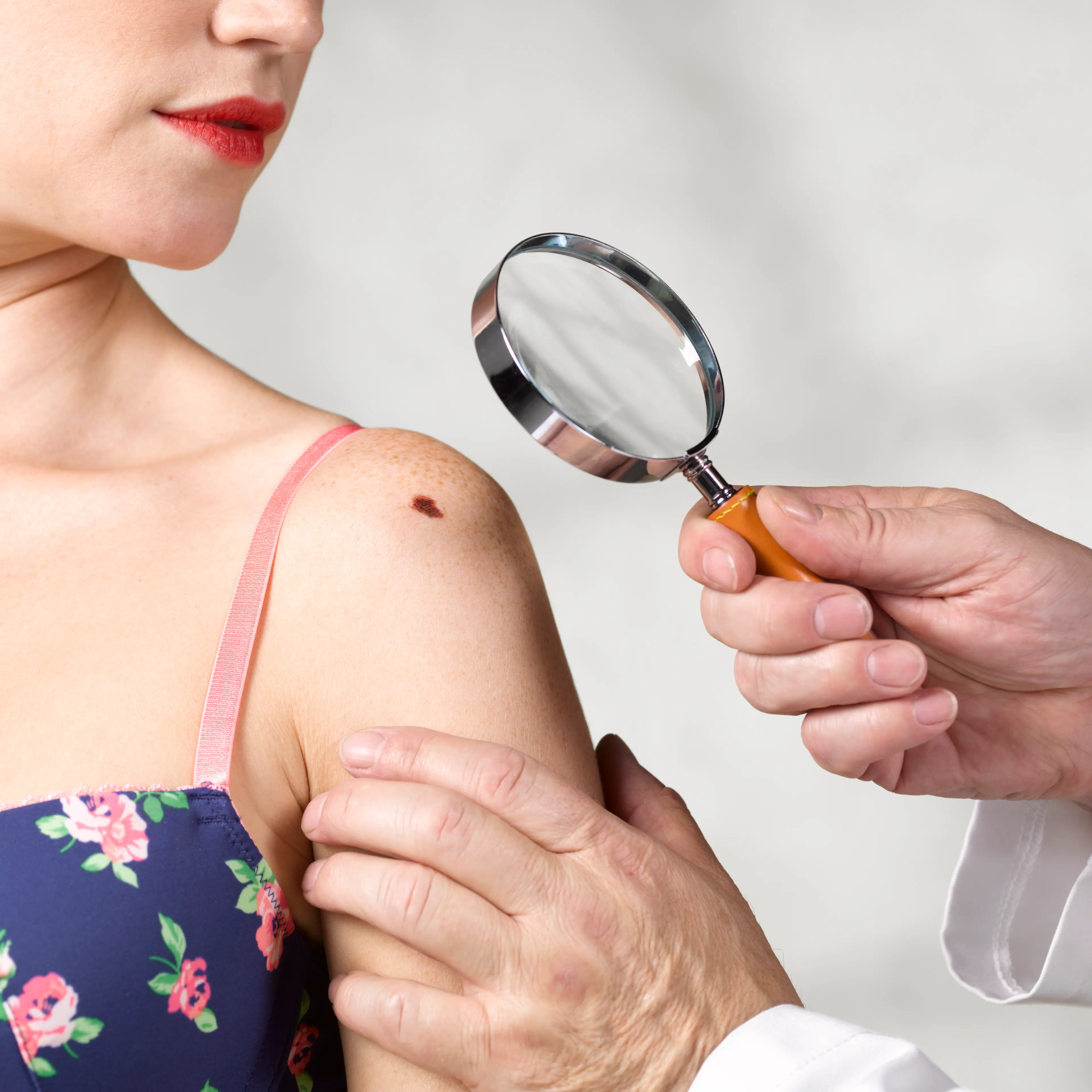 Dermatologist inspecting melanoma
