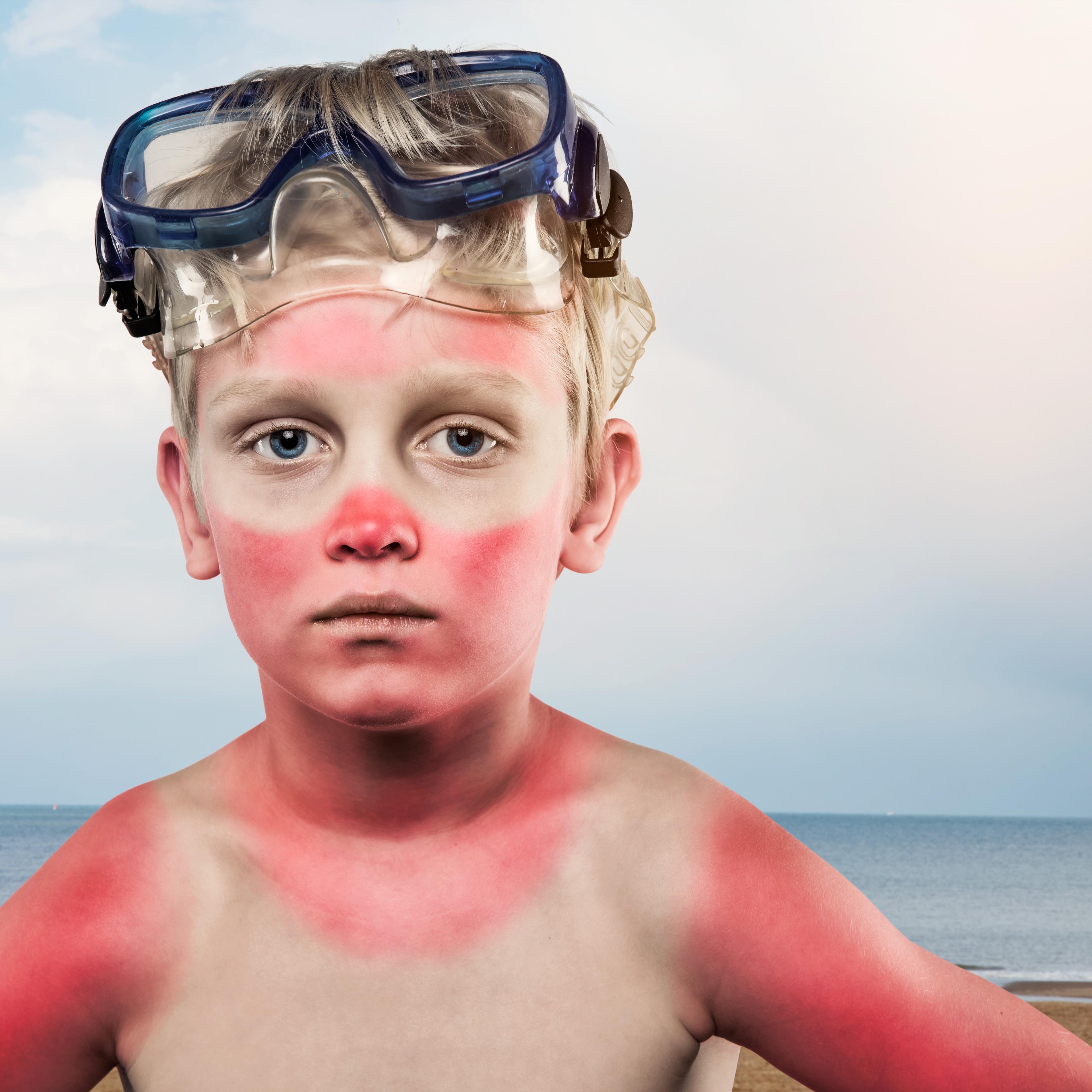 Sunburned boy