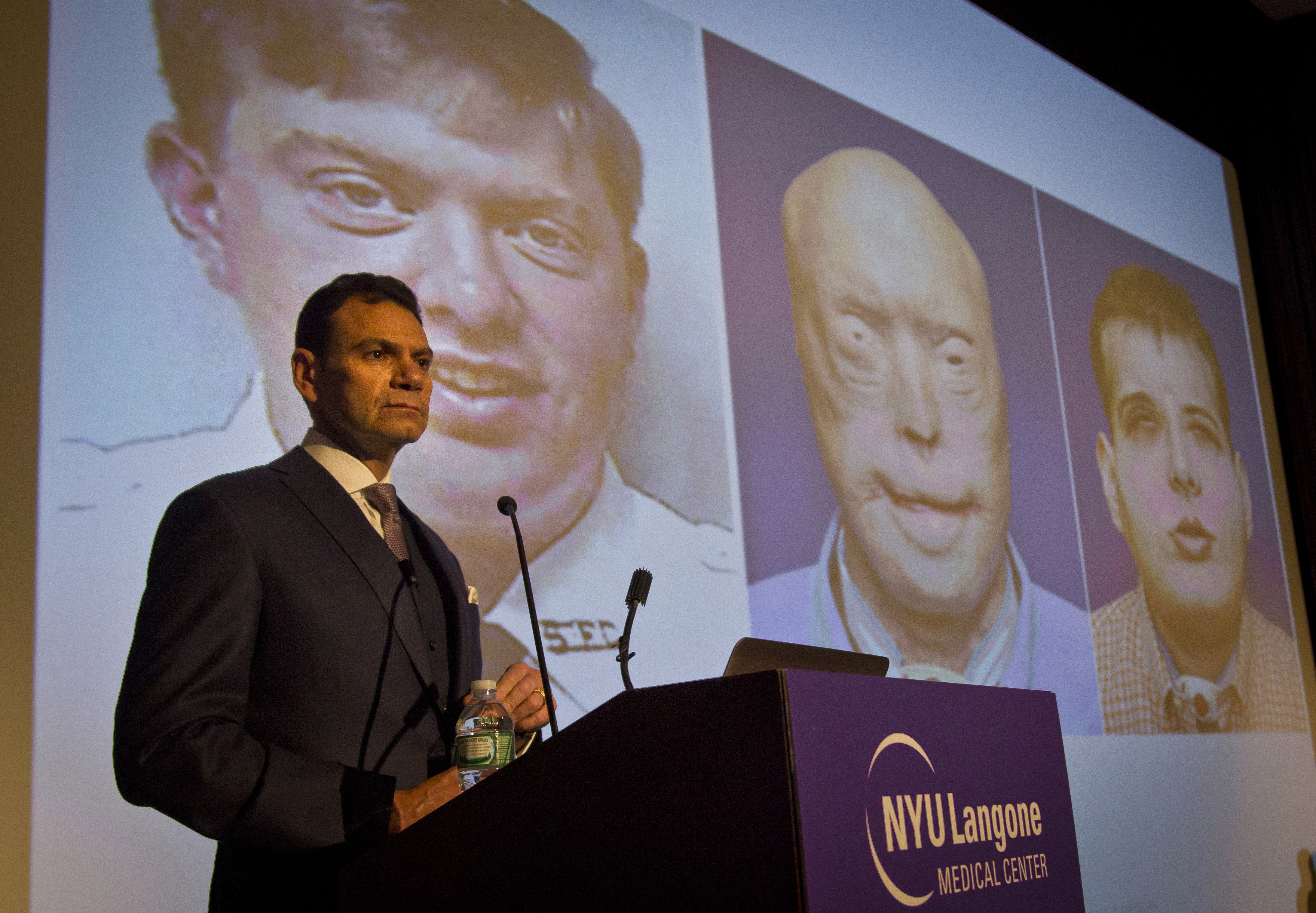 Dr. Eduardo Rodriguez, who led the surgical team that did the face transplant on Patrick Hardison, a volunteer firefighter who was badly burned in a 2001 blaze, speaks during a news conference as he shows before-and-after images of Hardison in New York o