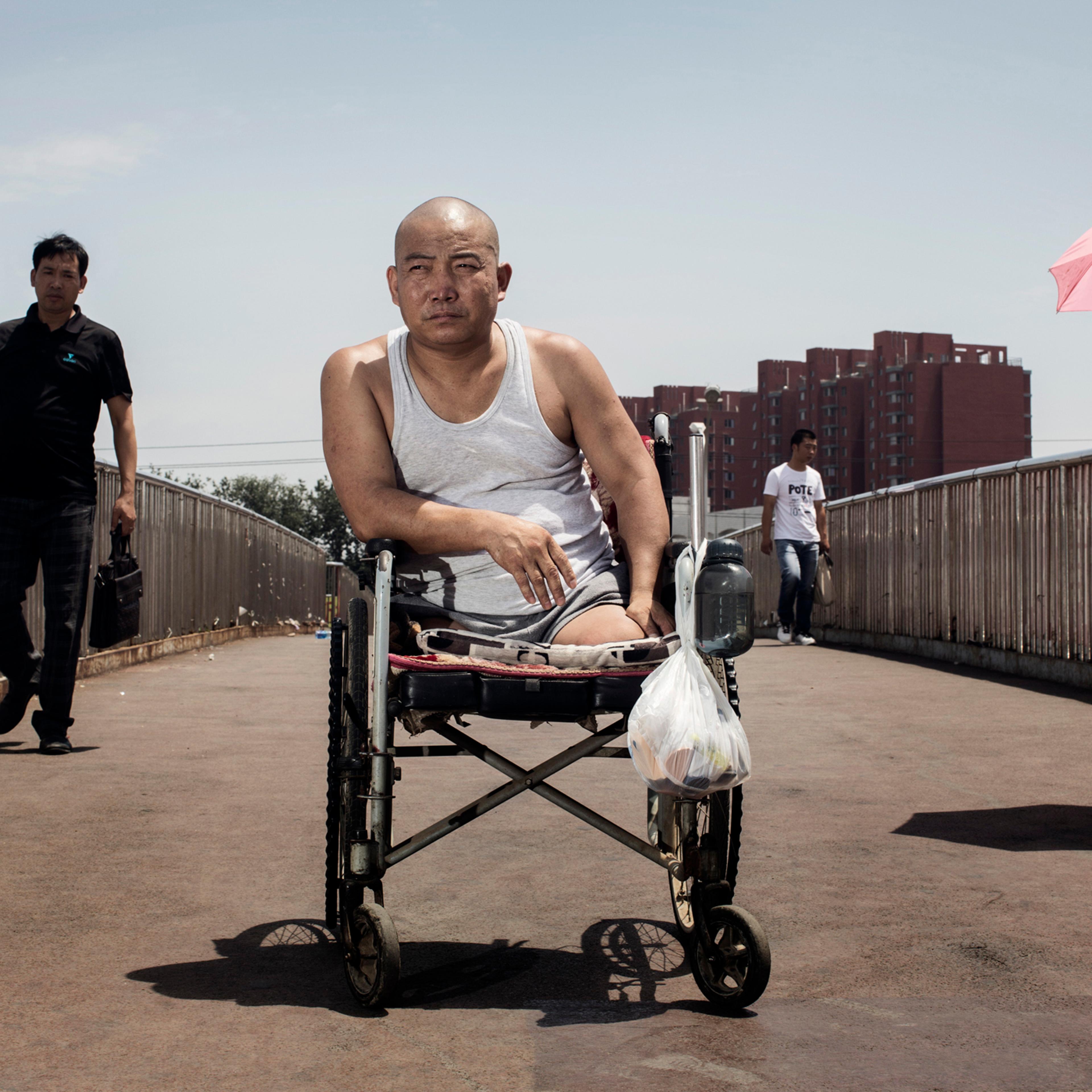 Hebei farmer Zheng currently in Beijing where he is having prothesis made. July 2014.
