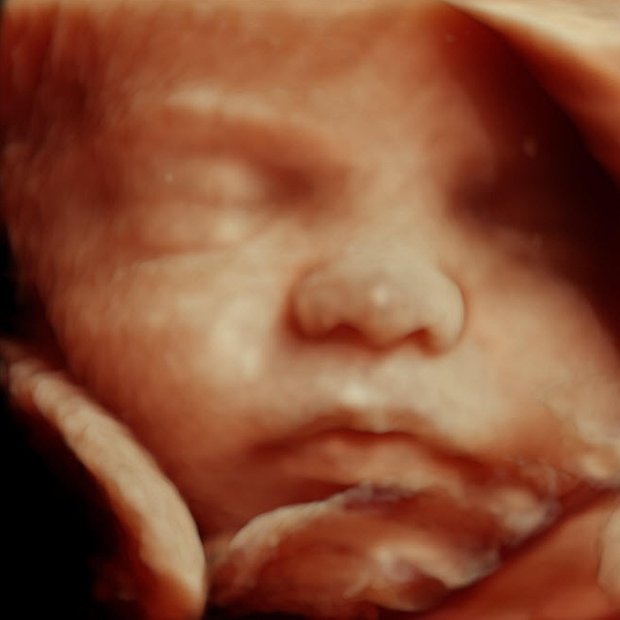 Gestation: 32 weeks.