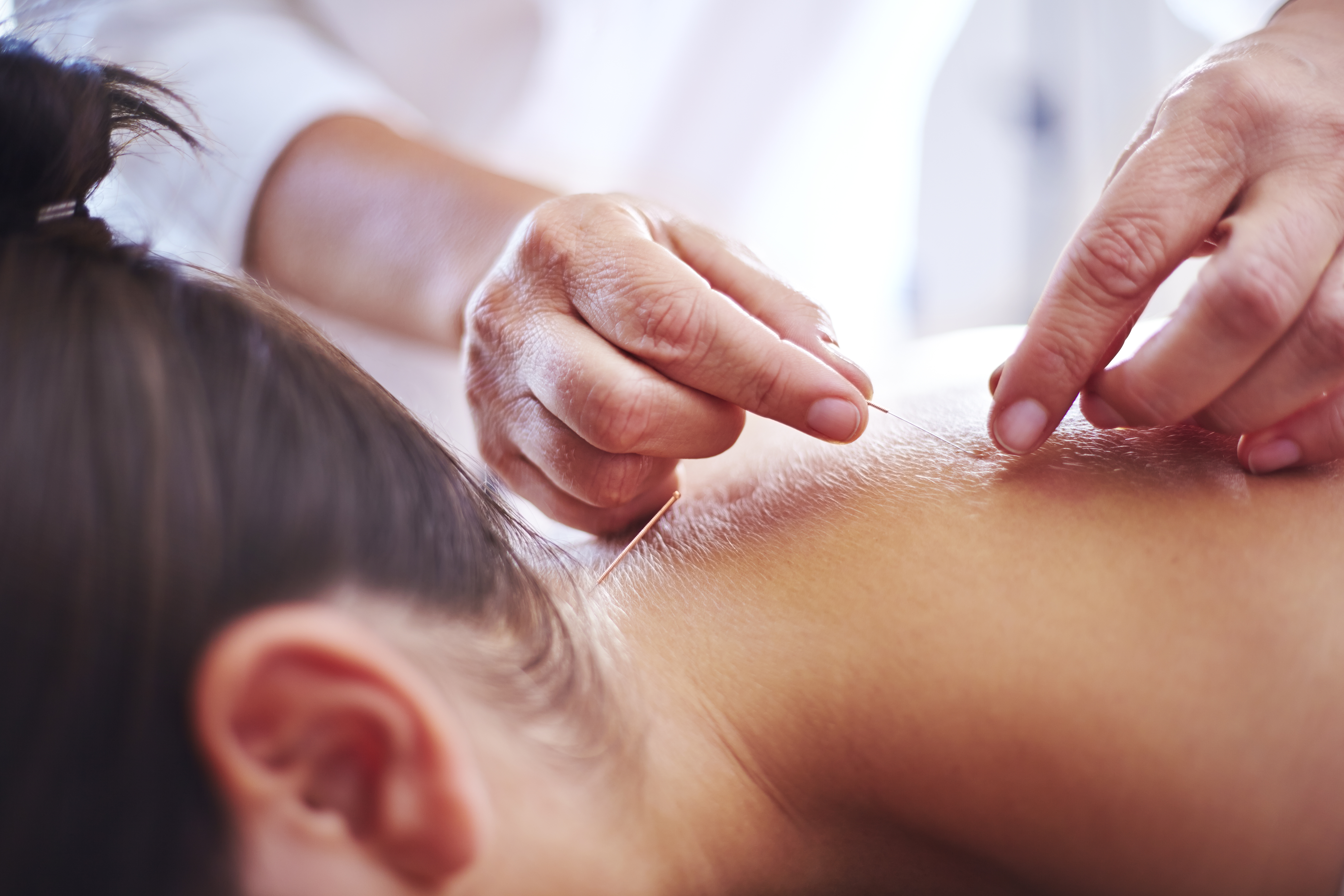 Close up acupuncturist applying acupuncture needles to womans neck
