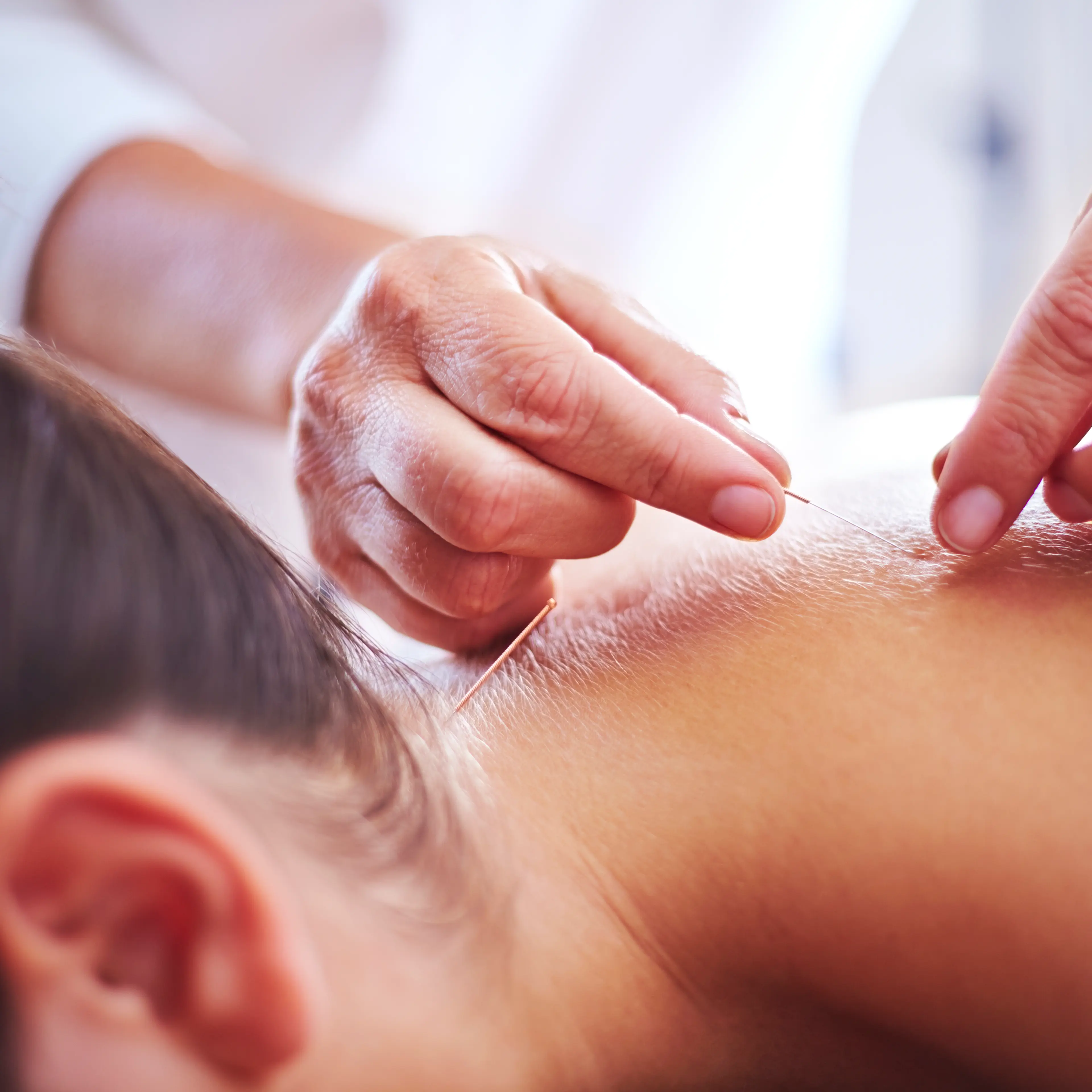 Close up acupuncturist applying acupuncture needles to womans neck