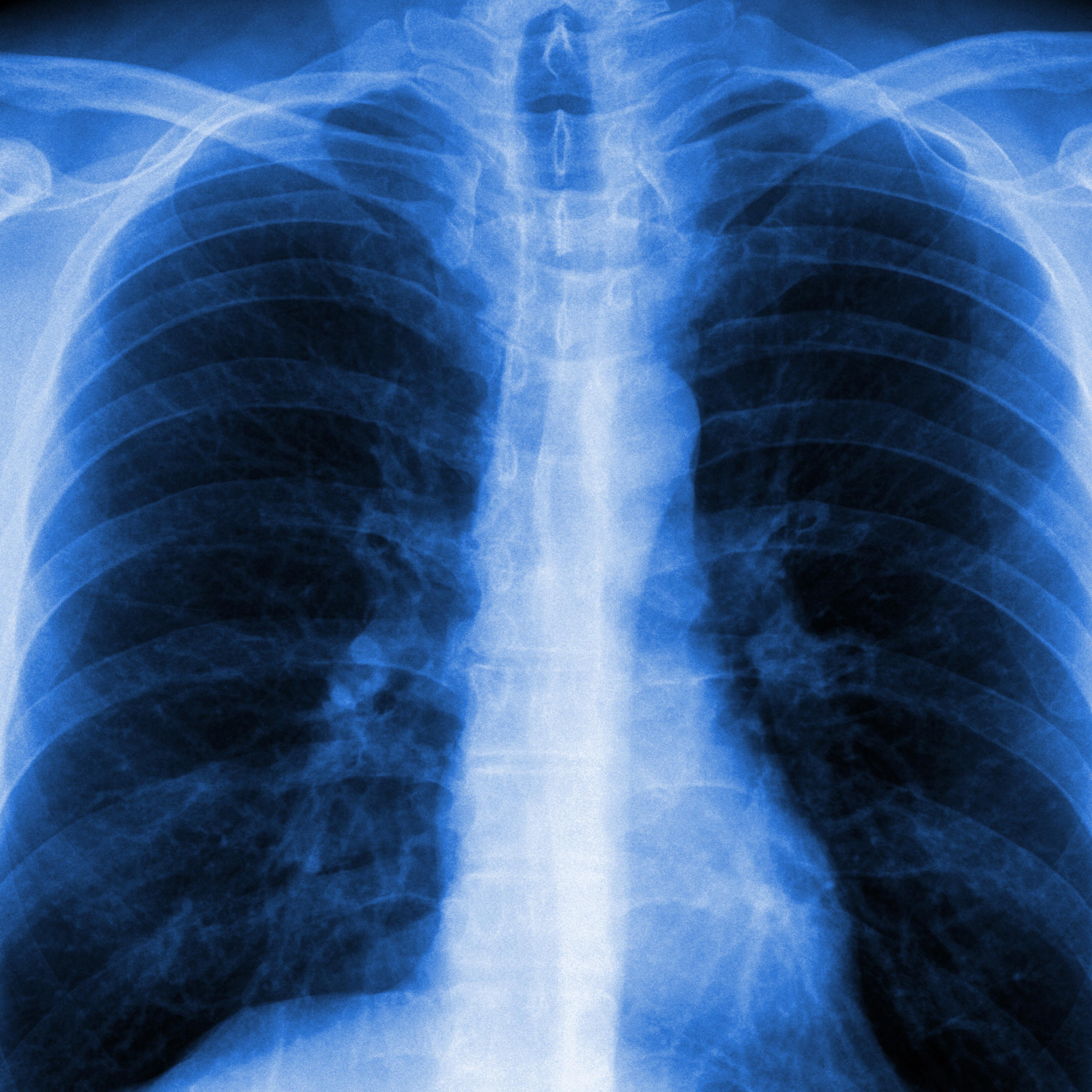 lung xray