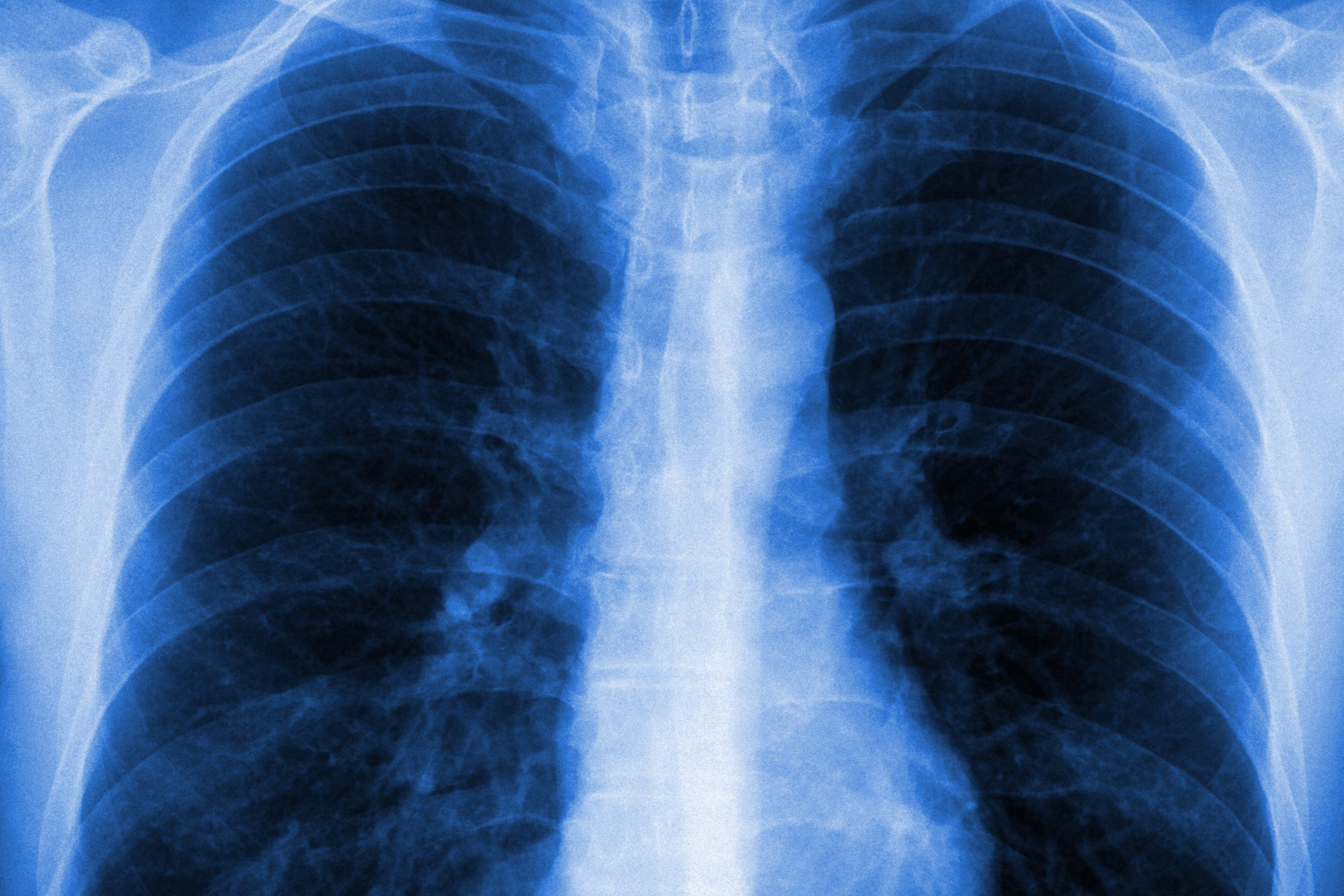 lung xray
