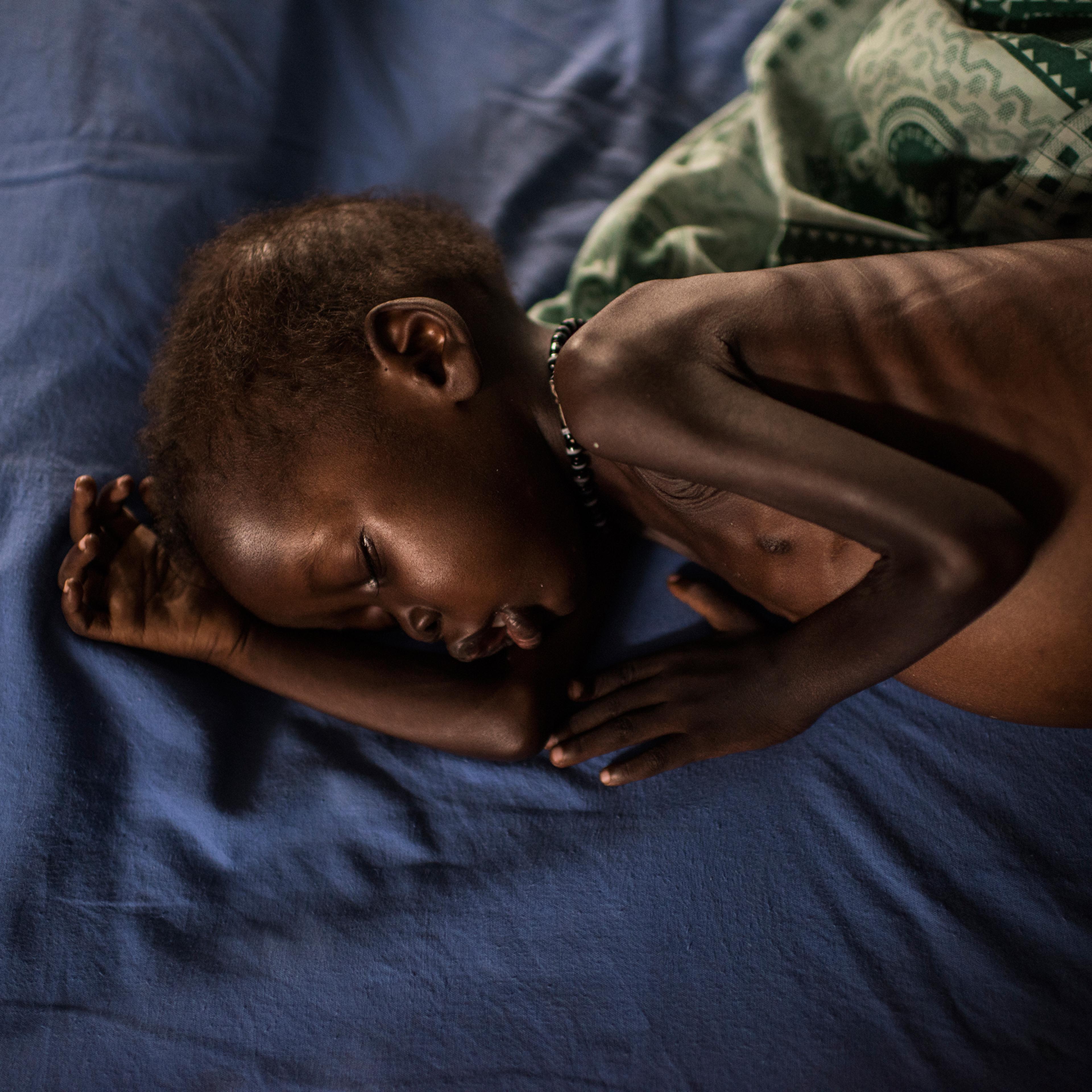 A severely malnourished child from Leer receives treatment at the inpatient ward run by International Medical Corps at the Protection of Civilians site in Juba, March 22, 2016.