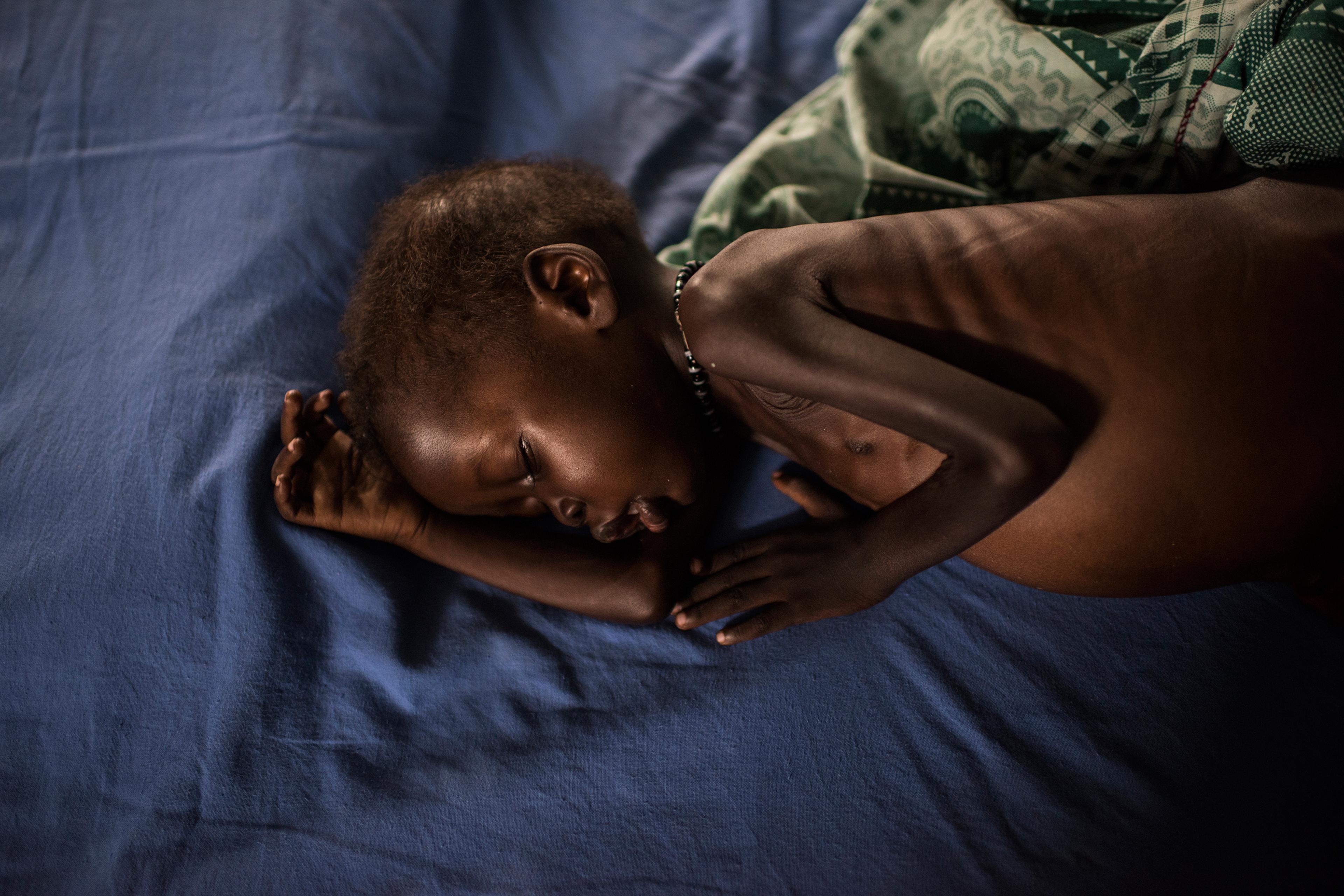 A severely malnourished child from Leer receives treatment at the inpatient ward run by International Medical Corps at the Protection of Civilians site in Juba, March 22, 2016.