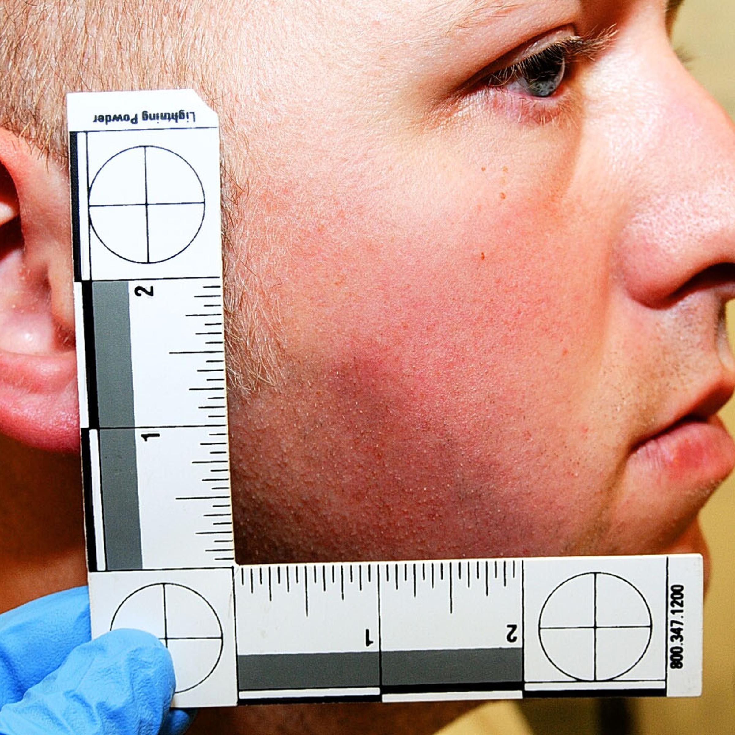 An undated evidence photograph made available by the St. Louis County prosecutors office on Nov. 25, 2014 shows Ferguson police officer Darren Wilson during his medical examination after the shooting of Michael Brown.