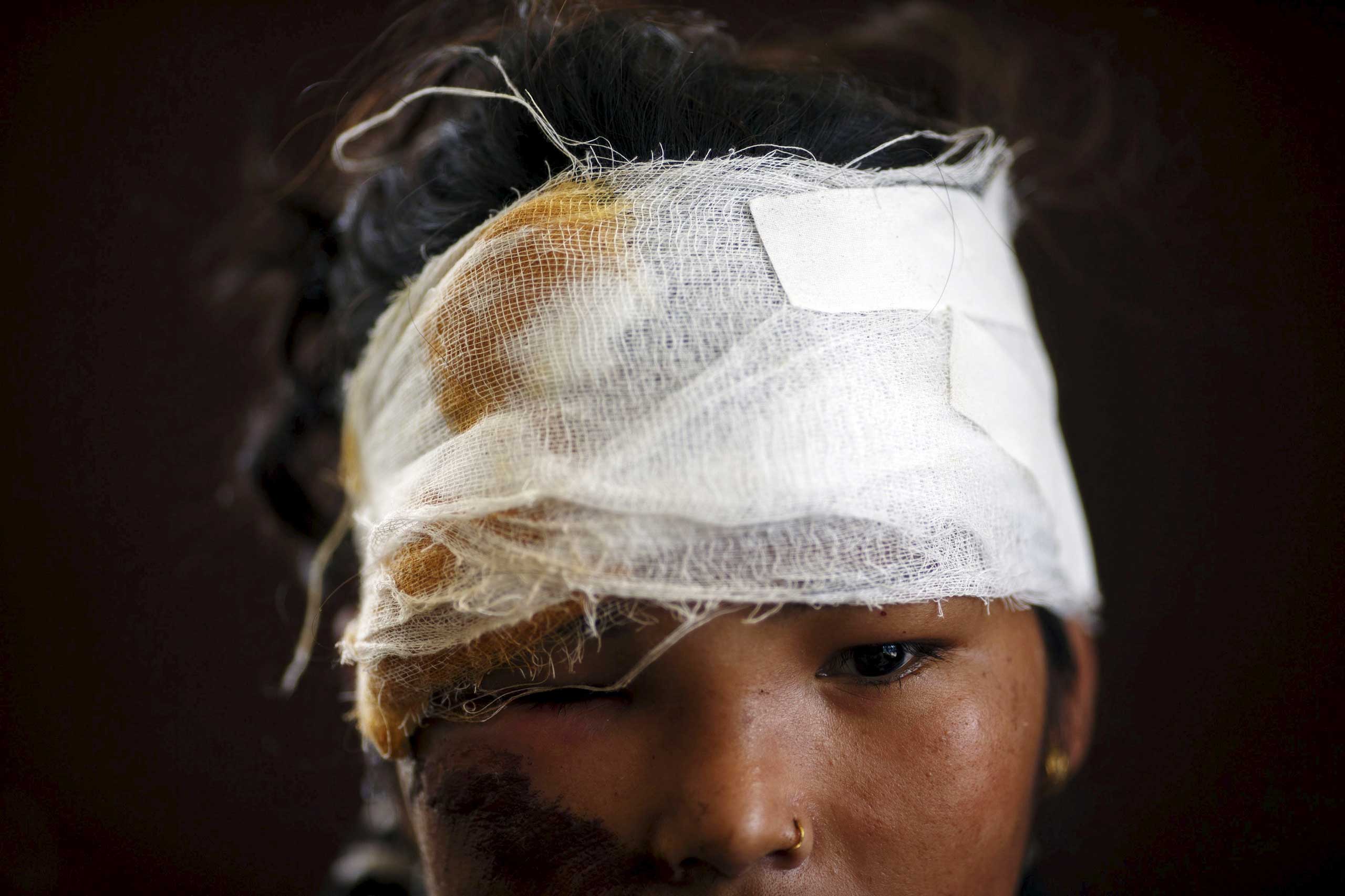 A woman with injuries to the head and right eye looks on, in the aftermath of Saturday's earthquake, at Dhading hospital, in Dhading Besi, Nepal on April 27, 2015.