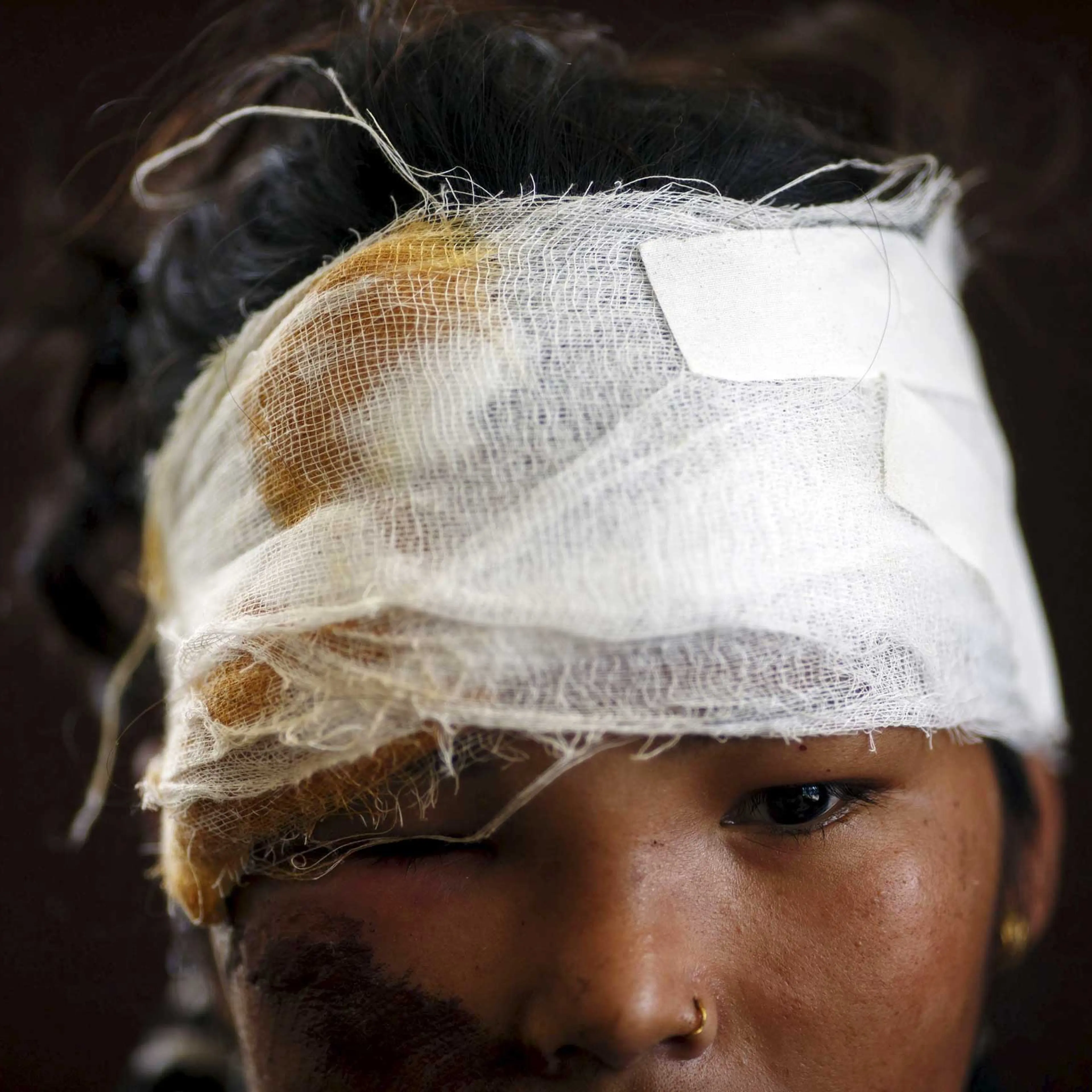A woman with injuries to the head and right eye looks on, in the aftermath of Saturday's earthquake, at Dhading hospital, in Dhading Besi, Nepal on April 27, 2015.