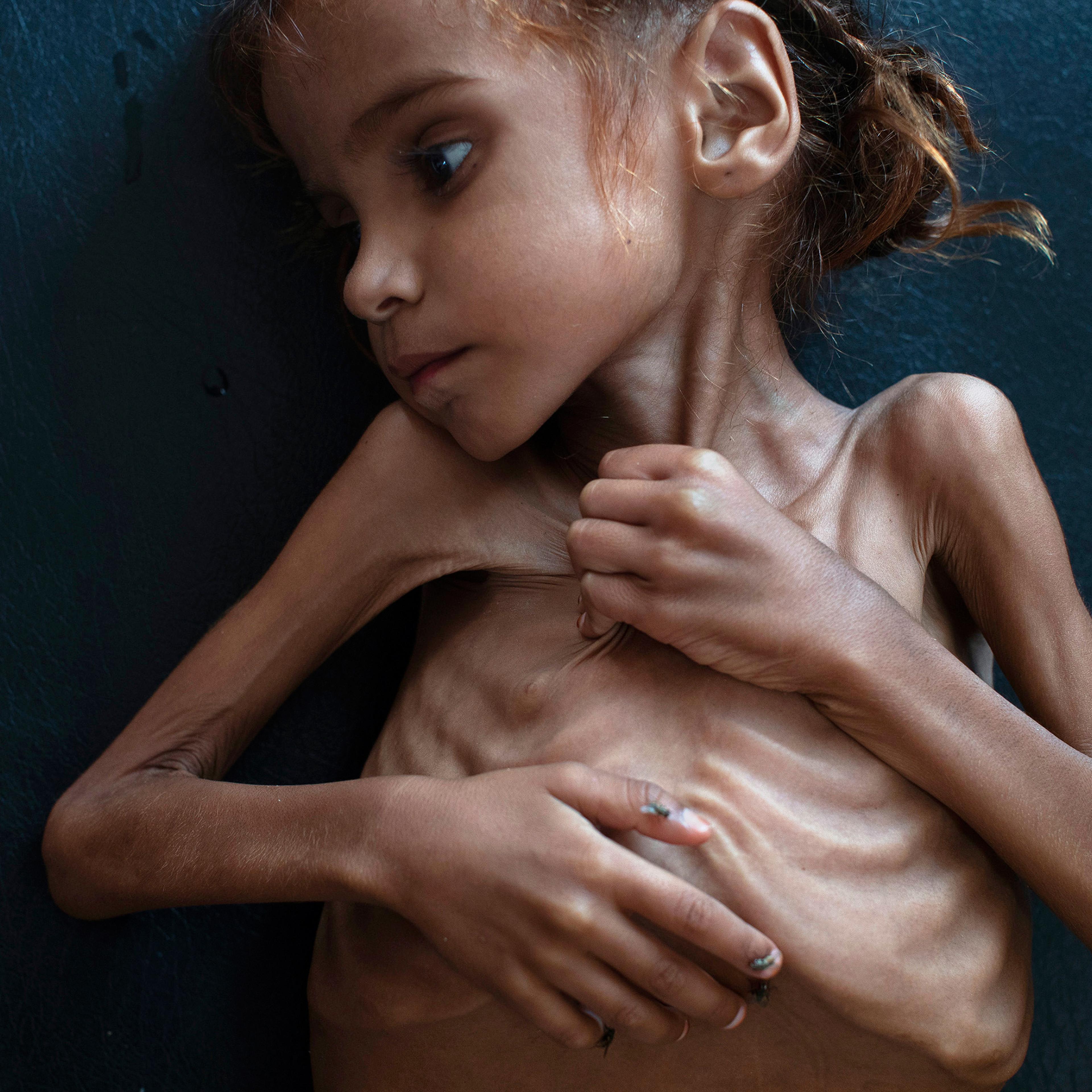 This image of 7-year-old Amal Hussain in October drew global attention to the humanitarian crisis