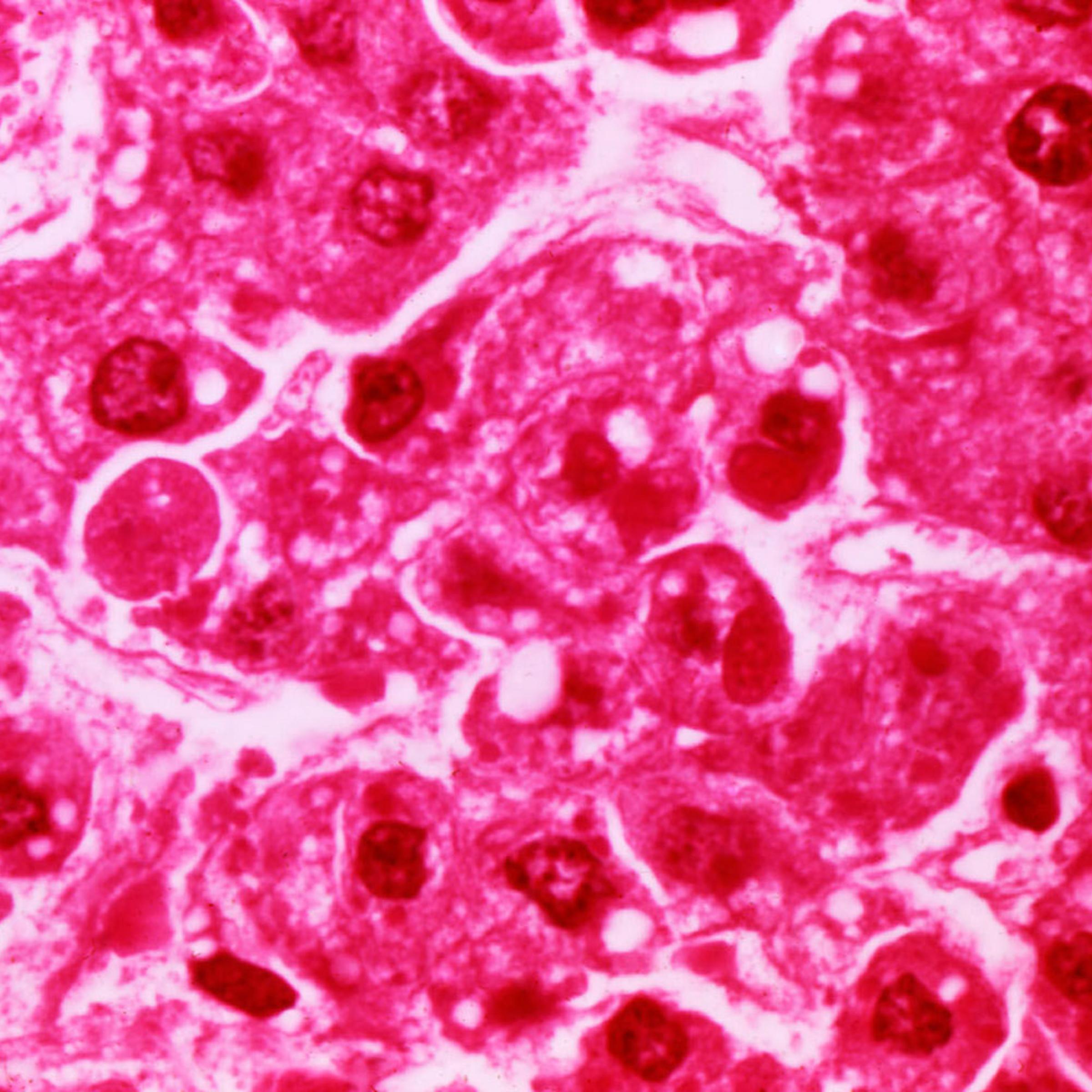 This micrograph reveals human hepatocytes infected with the Ebola virus, the cause of Ebola hemorrhagic fever.