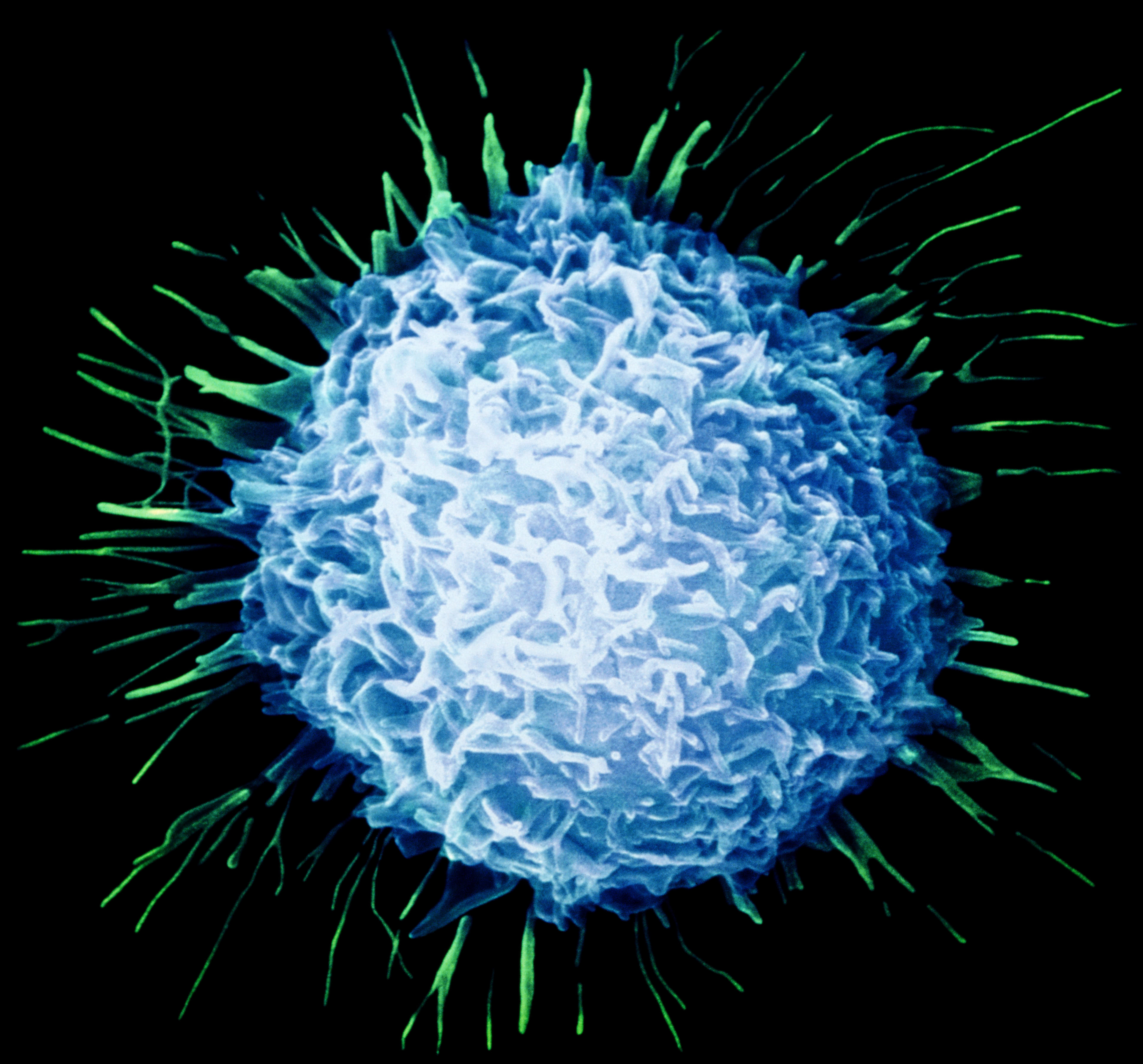 Prostate cancer cell.